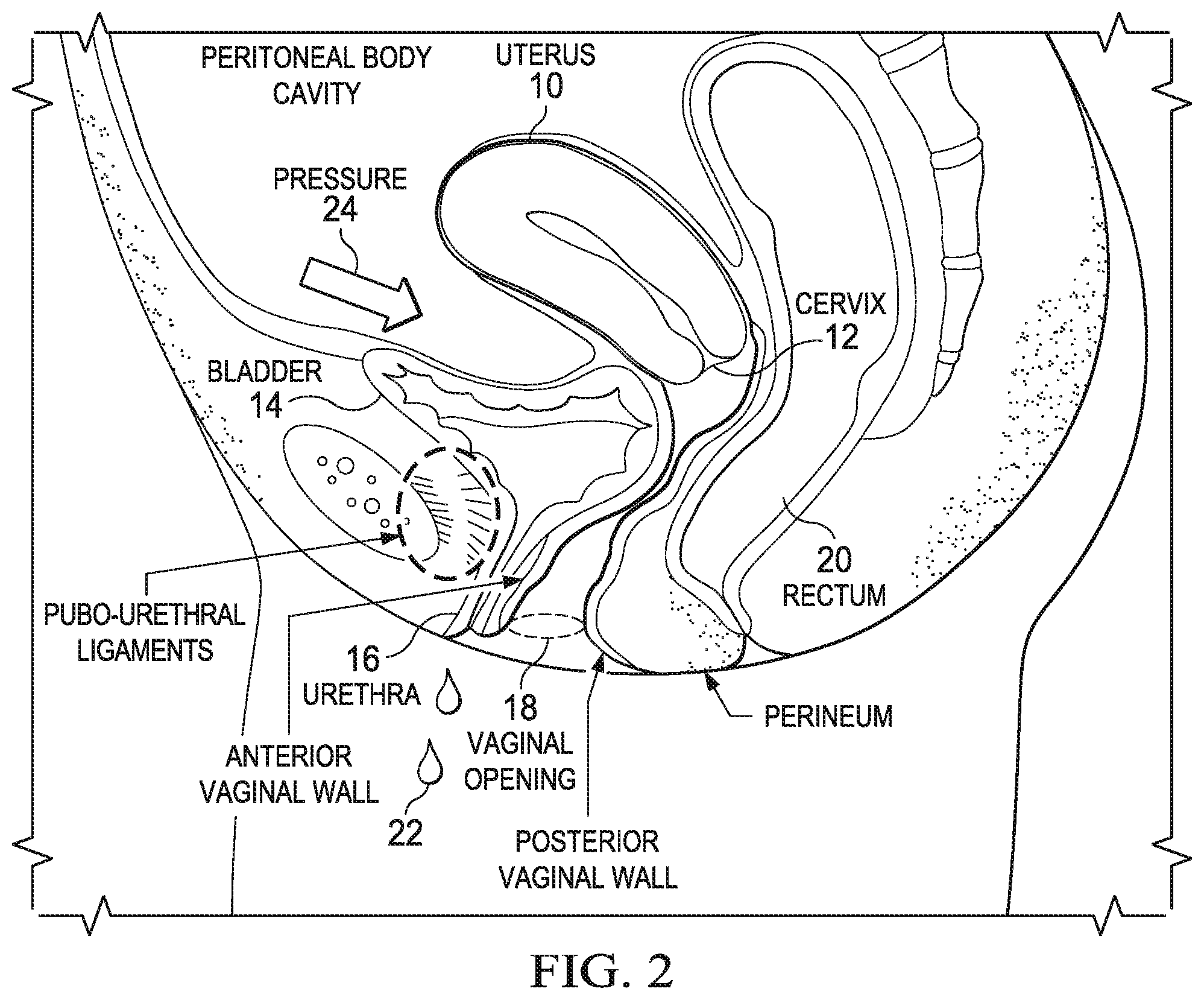Patent US12472092 Figure 2 – Flexible cone-shaped intra-vaginal support device
