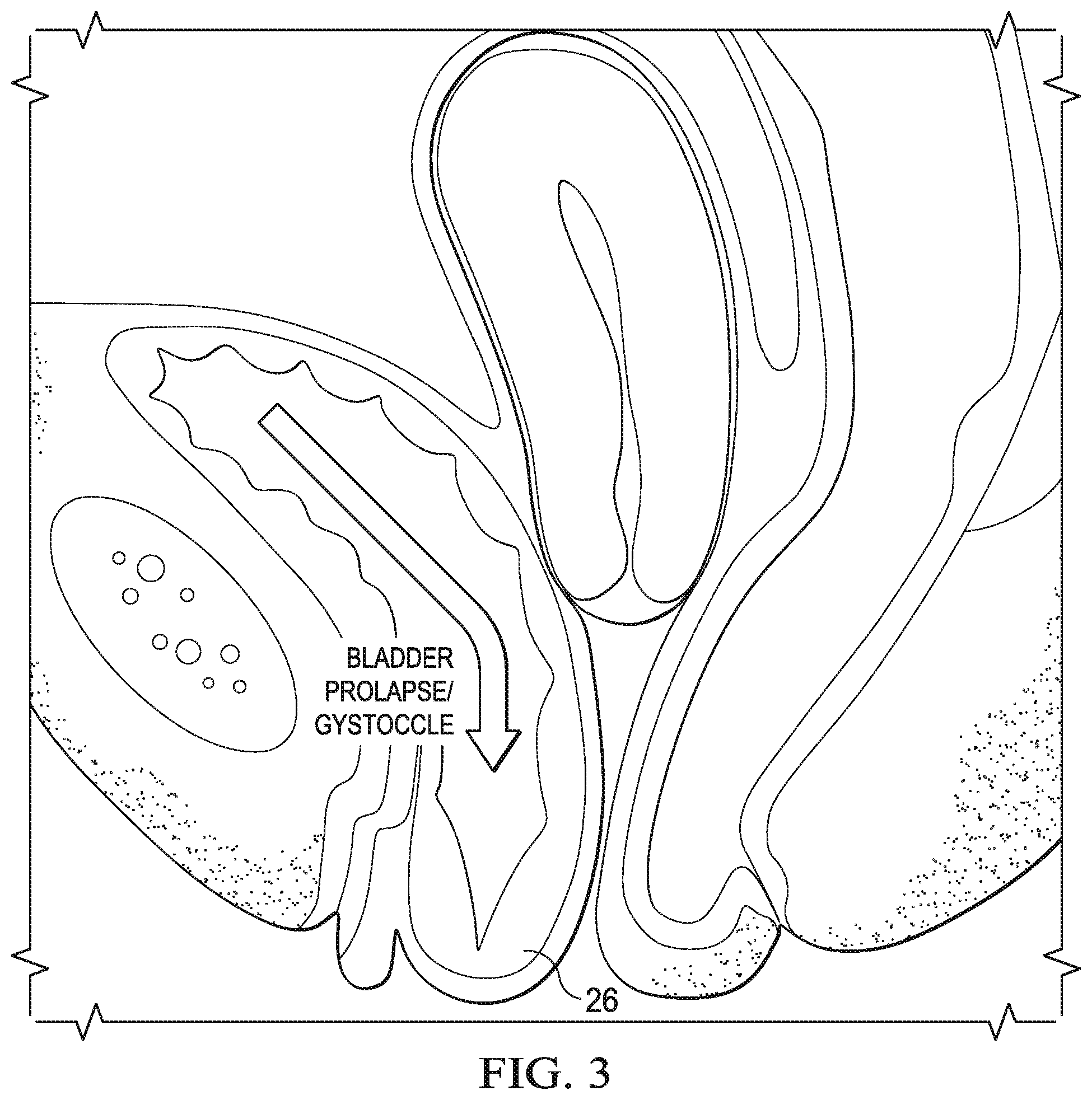 Patent US12472092 Figure 3 – Flexible cone-shaped intra-vaginal support device