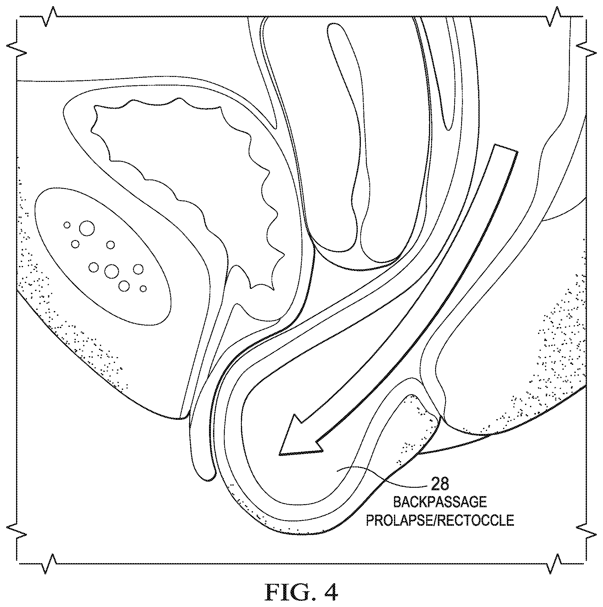 Patent US12472092 Figure 4 – Flexible cone-shaped intra-vaginal support device