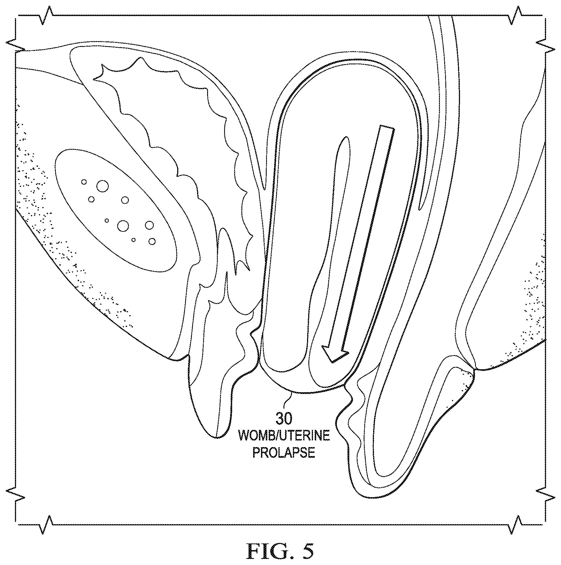 Patent US12472092 Figure 5 – Flexible cone-shaped intra-vaginal support device