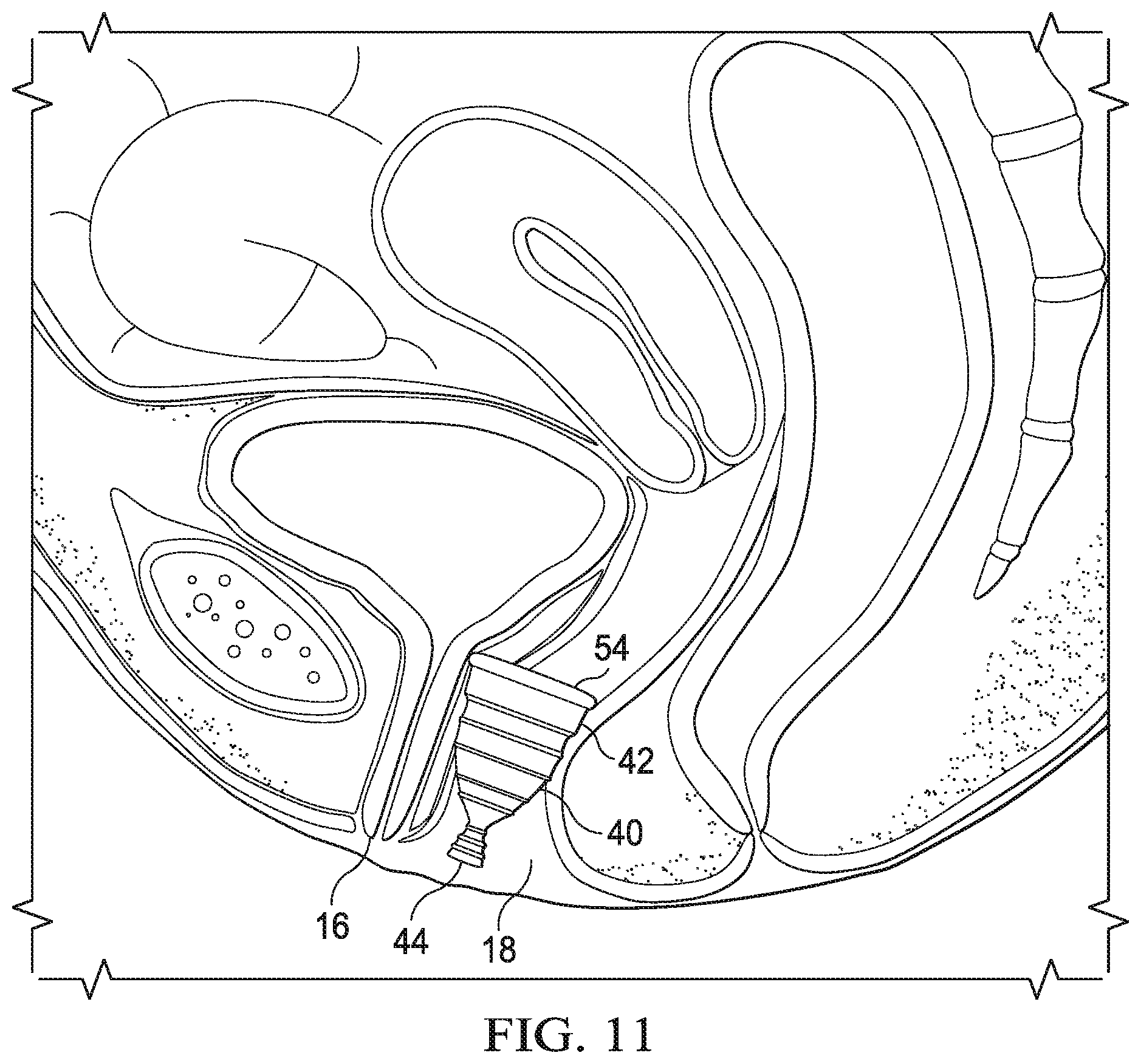 Patent US12472092 Figure 12 – Flexible cone-shaped intra-vaginal support device