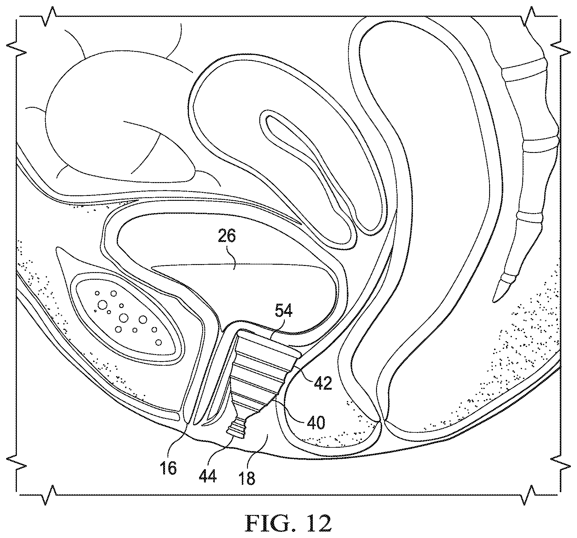 Patent US12472092 Figure 13 – Flexible cone-shaped intra-vaginal support device