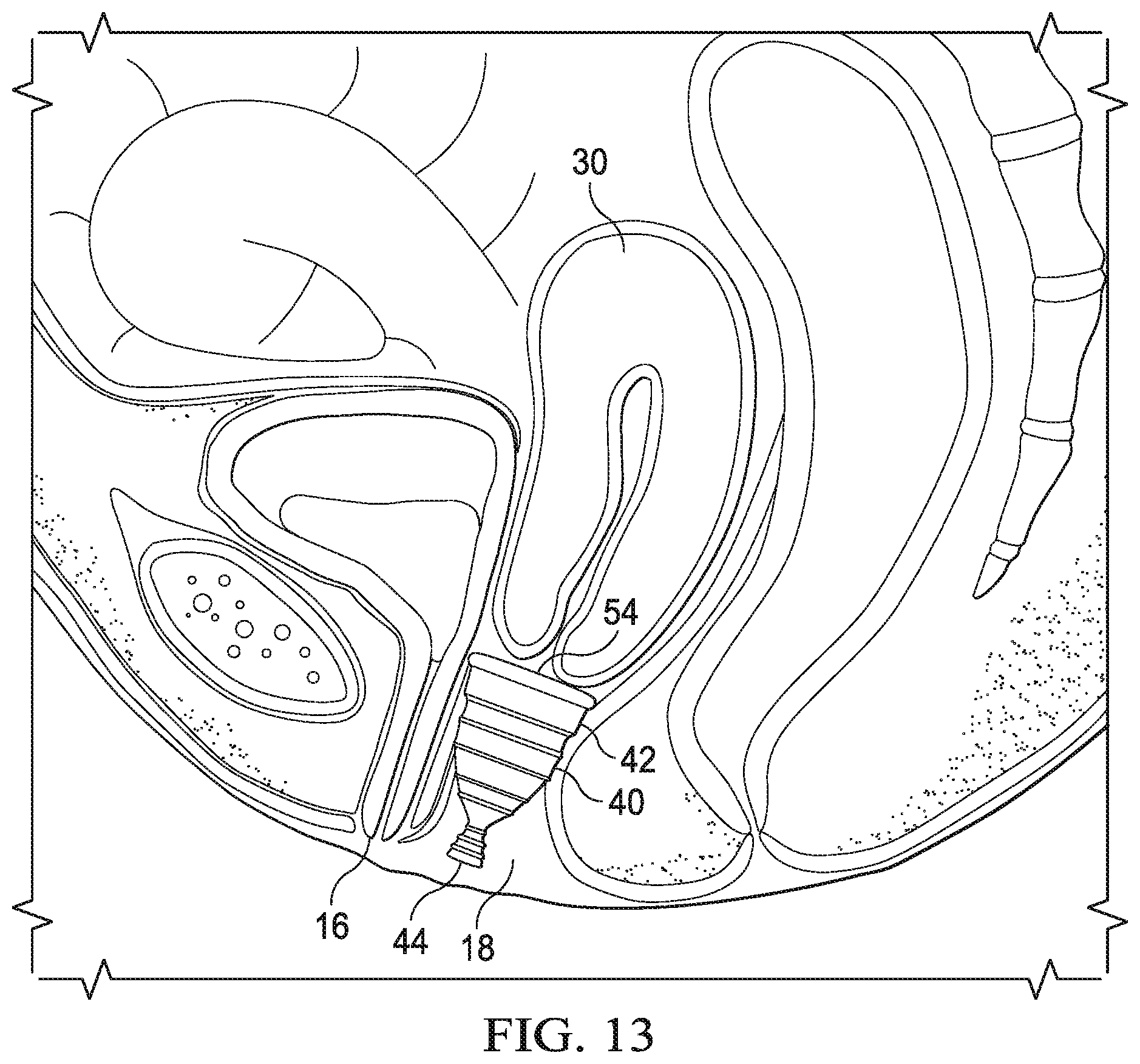 Patent US12472092 Figure 14 – Flexible cone-shaped intra-vaginal support device