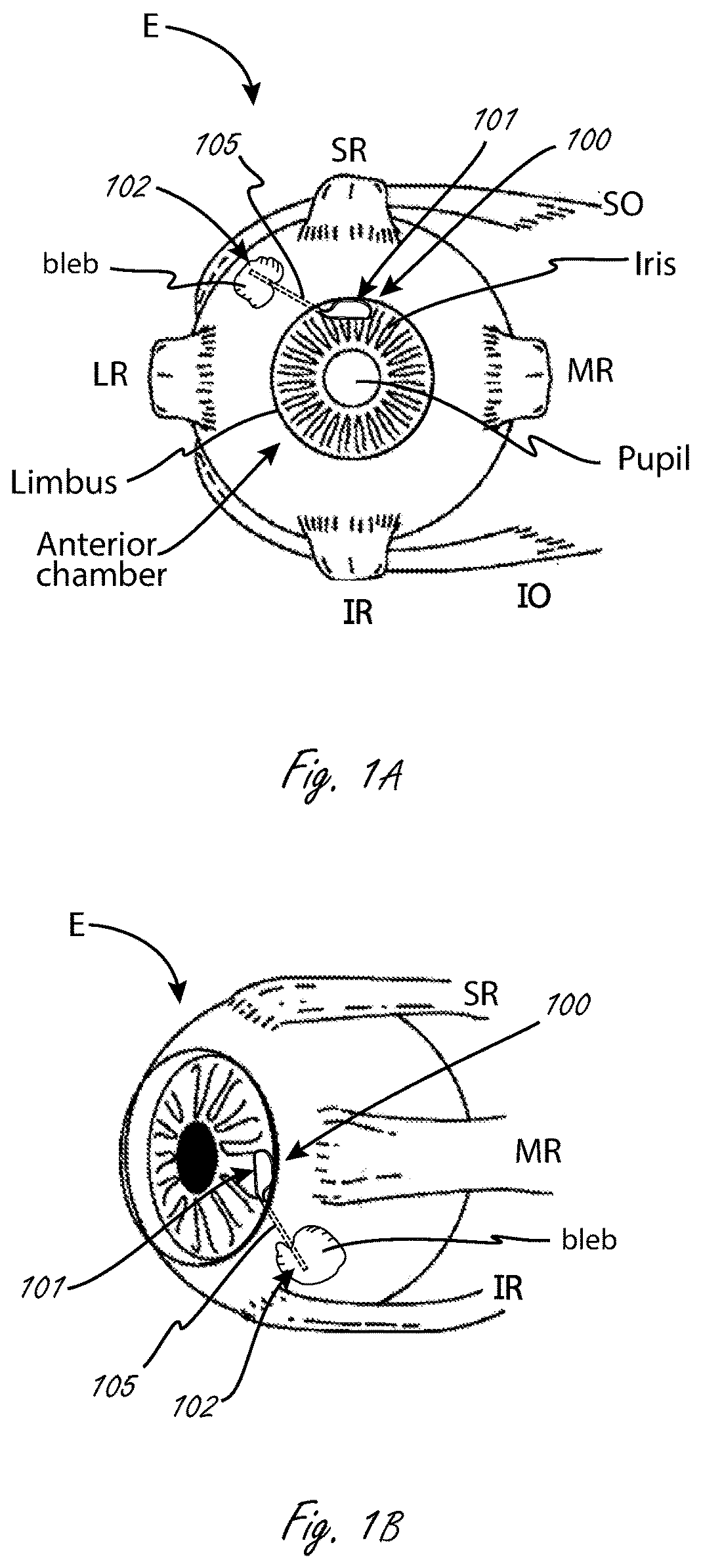 Patent US12472097 Figure 1 – Adjustable flow glaucoma shunts and associated systems and methods