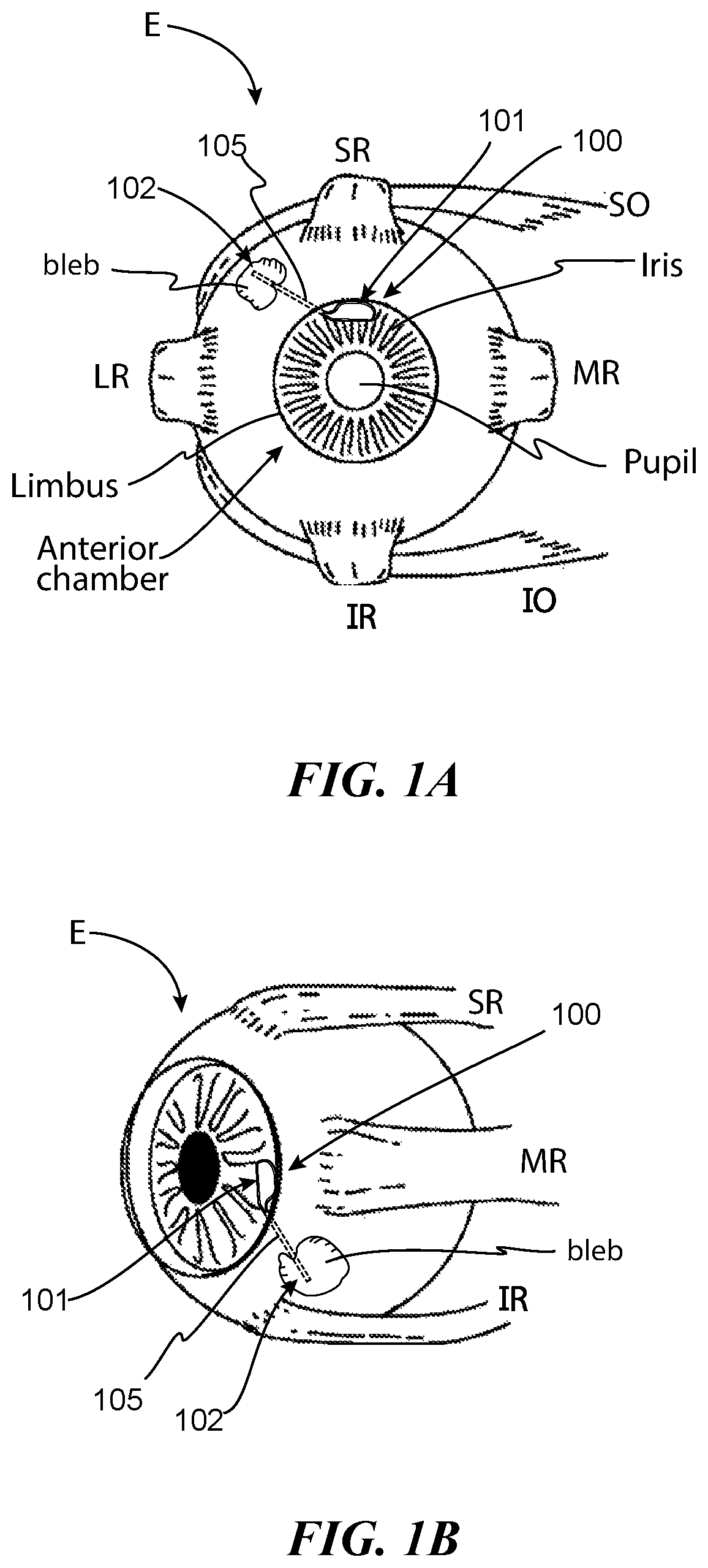 Patent US12472098 Figure 1 – Adjustable flow glaucoma shunts having non-linearly arranged flow control elements, and associated systems and methods