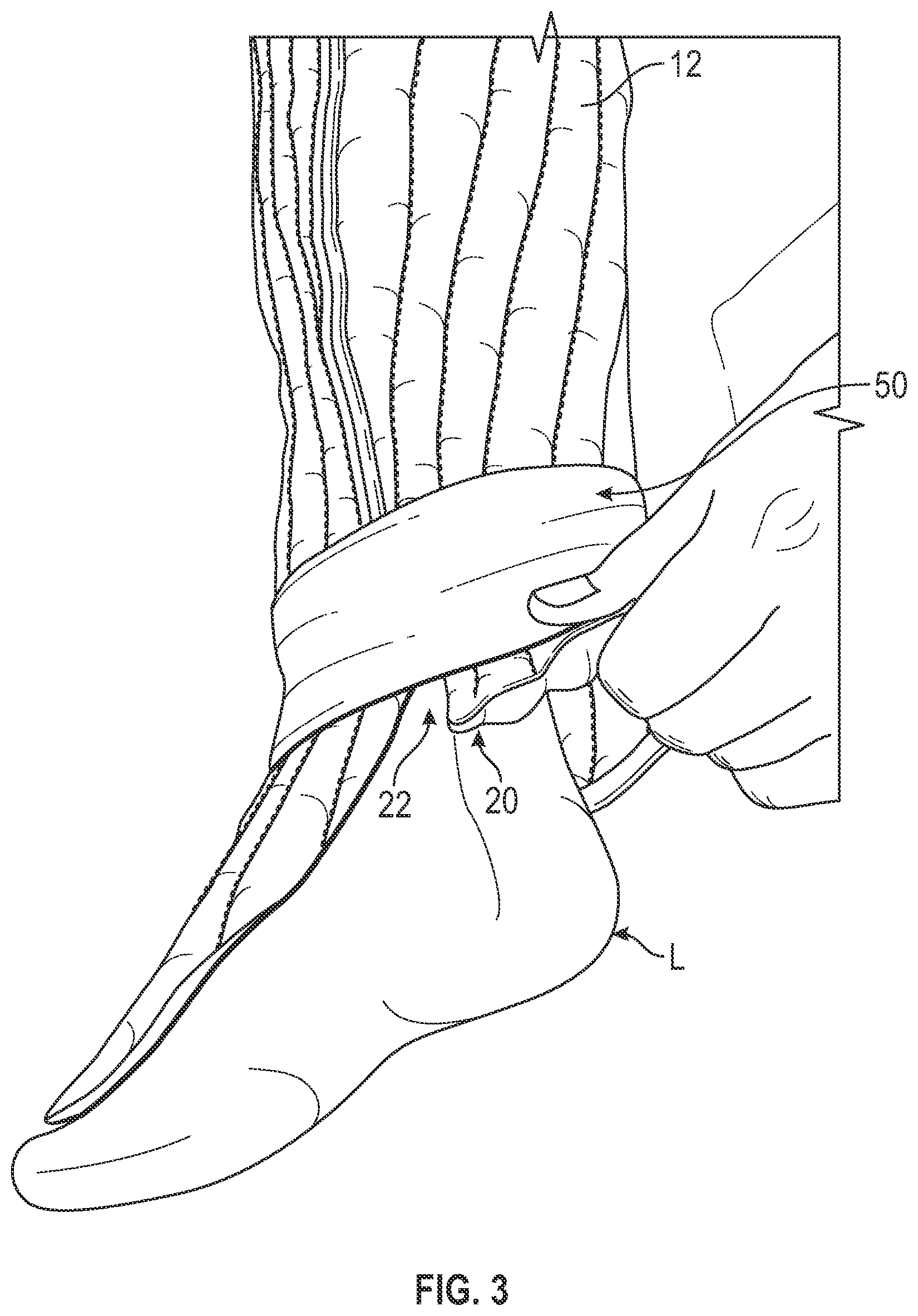Patent US12472105 Figure 3 – Foam sleeve garment with easy access feature