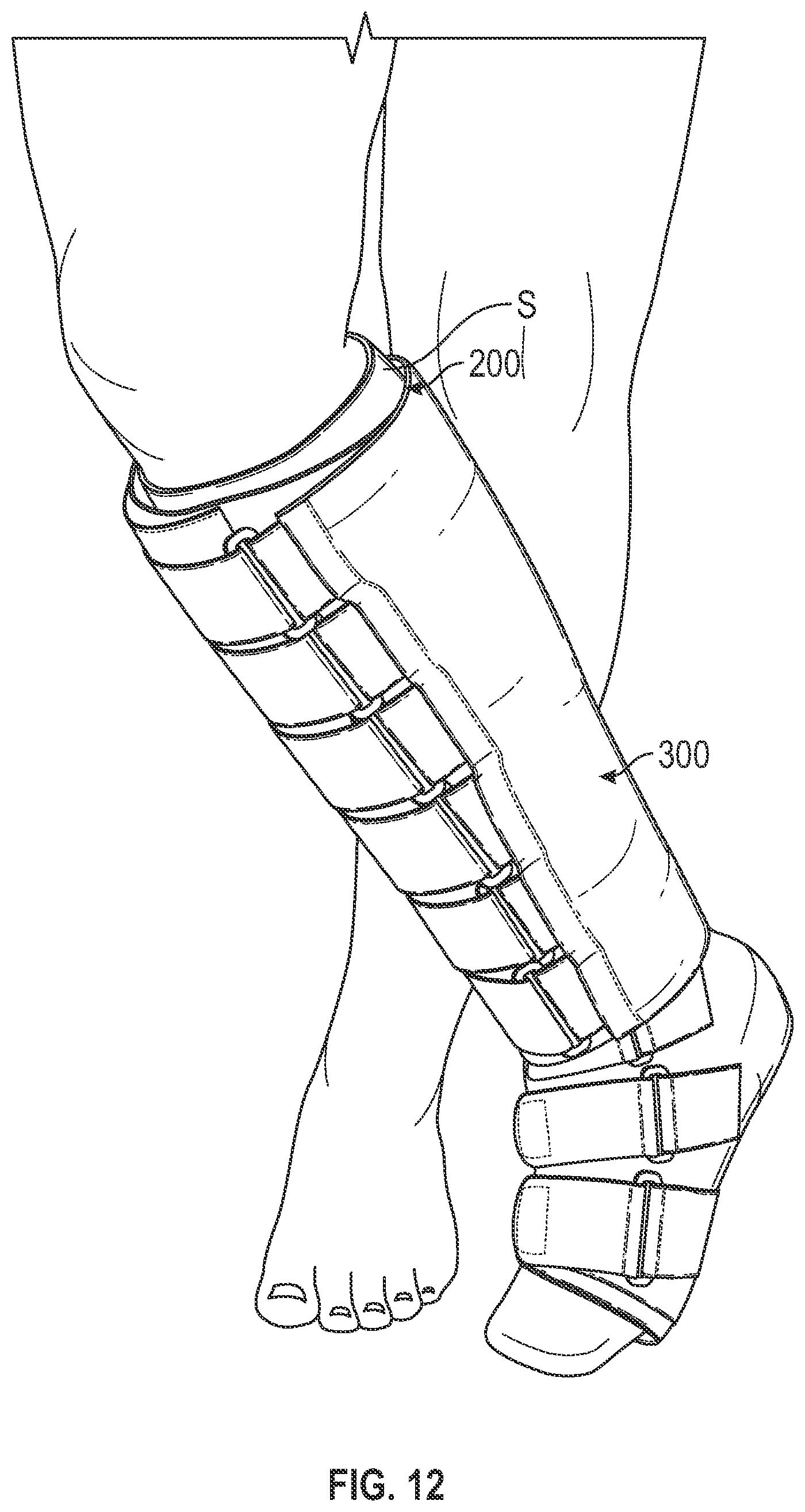 Patent US12472105 Figure 12 – Foam sleeve garment with easy access feature