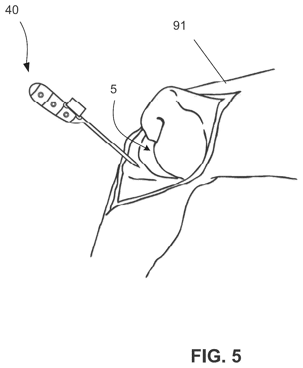Patent US12472117 Figure 5 – Systems and methods for assisting surgery