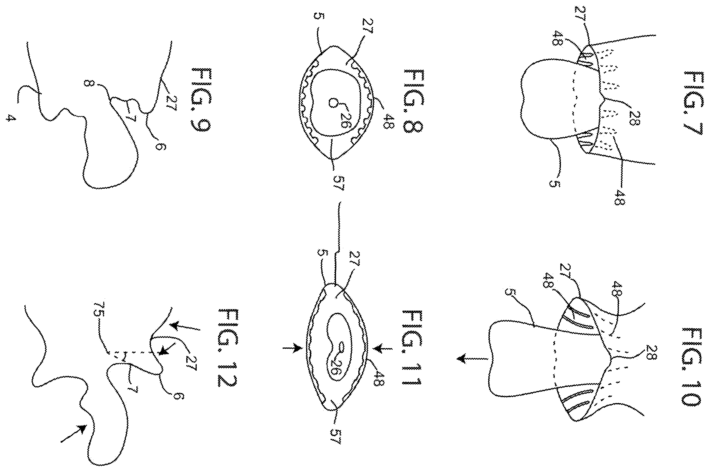 Patent US12472126 Figure 5 – Orthotropic and orthognathic oral device and method