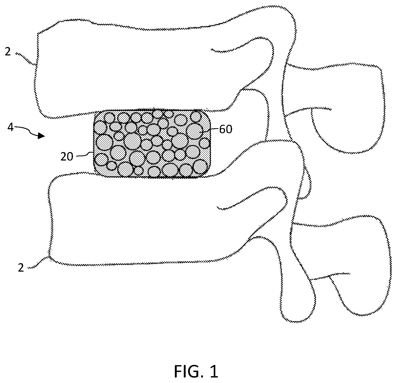 Patent US12472141 Figure 1 – Drug delivery for intervertebral disc pain management