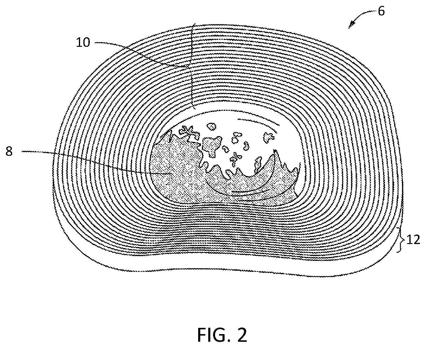 Patent US12472141 Figure 2 – Drug delivery for intervertebral disc pain management