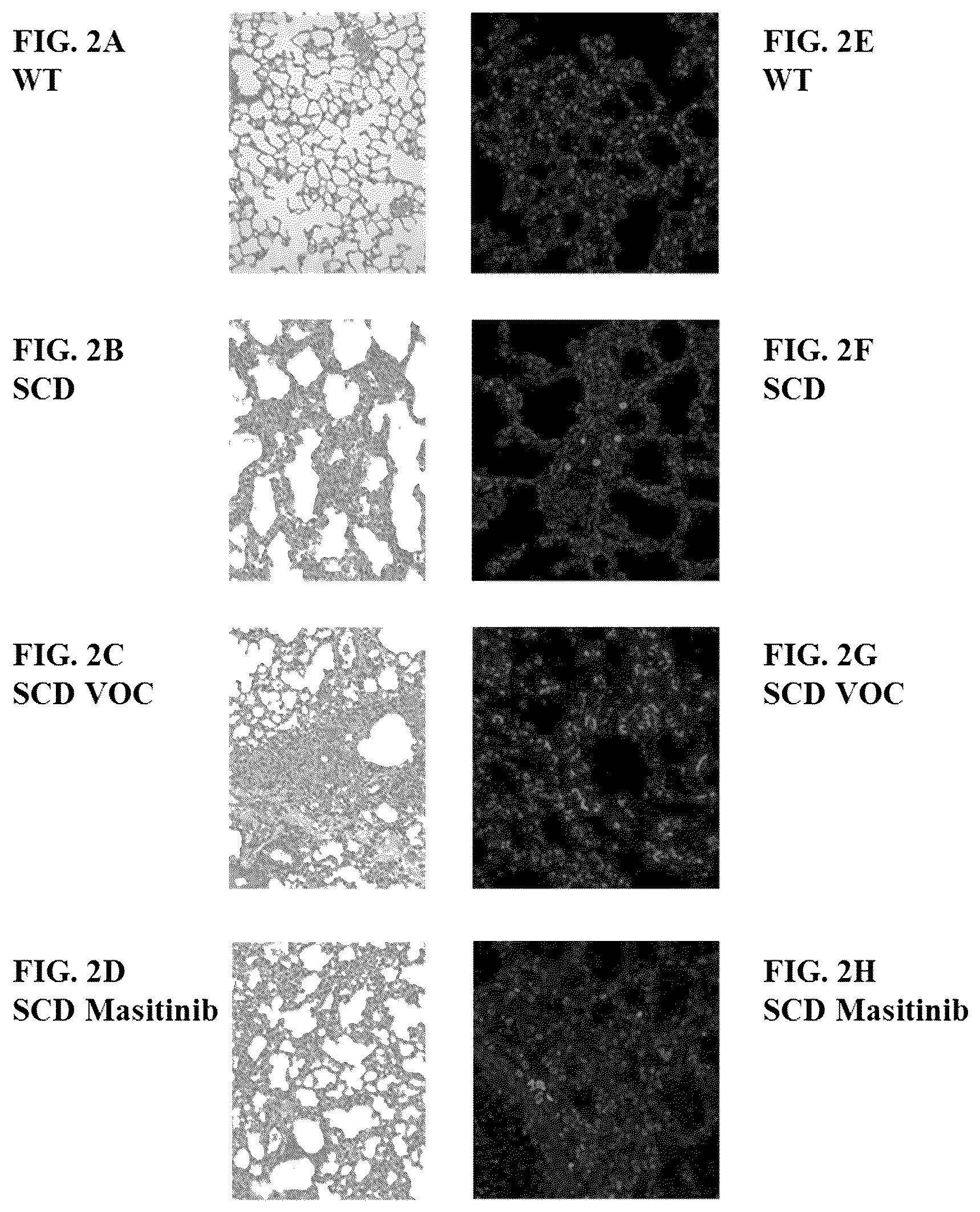 Patent US12472164 Figure 2 – Masitinib for the treatment of sickle cell disease