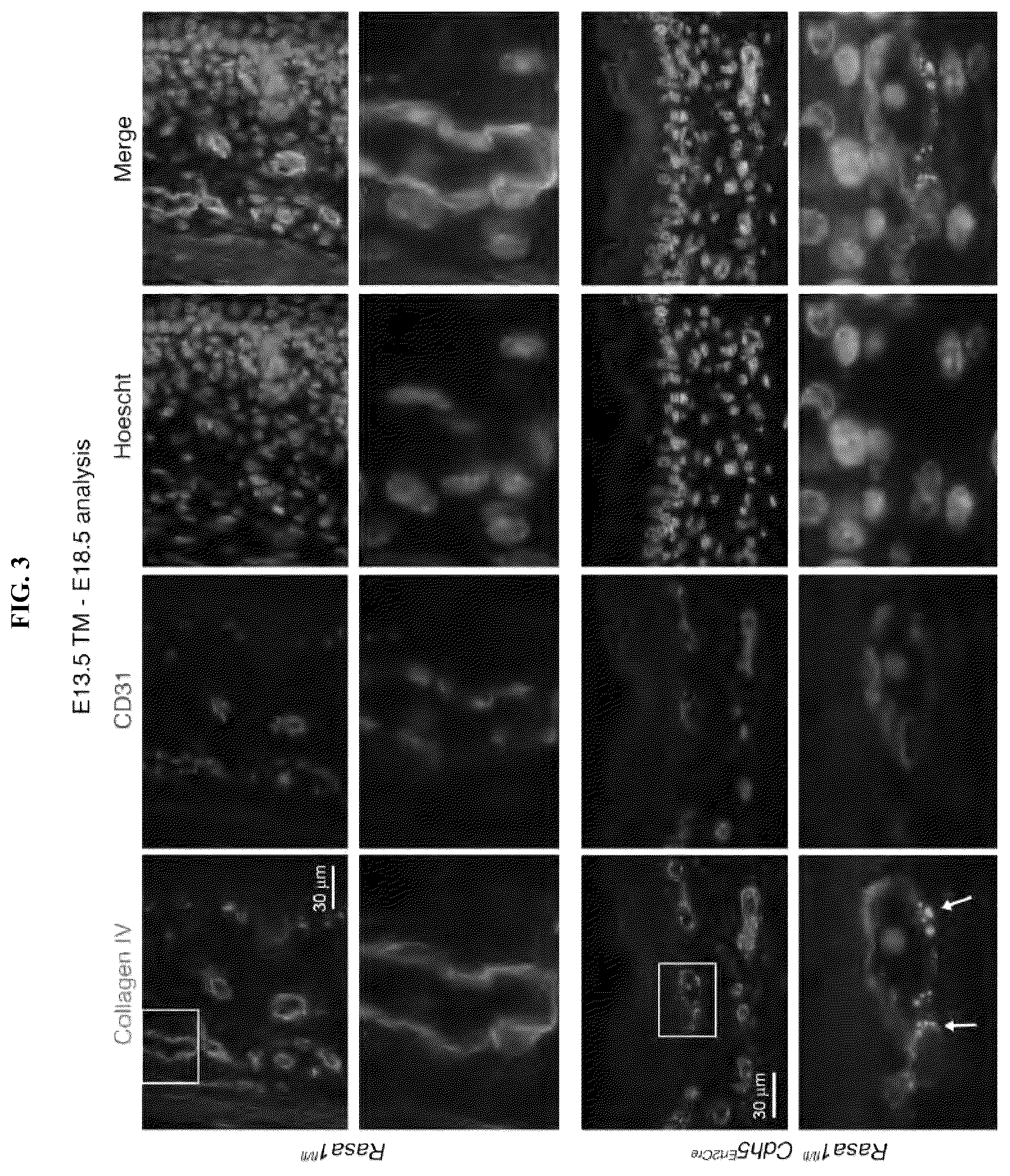 Patent US12472189 Figure 3 – Treatment and prevention of capillary malformation-arteriovenous malformation