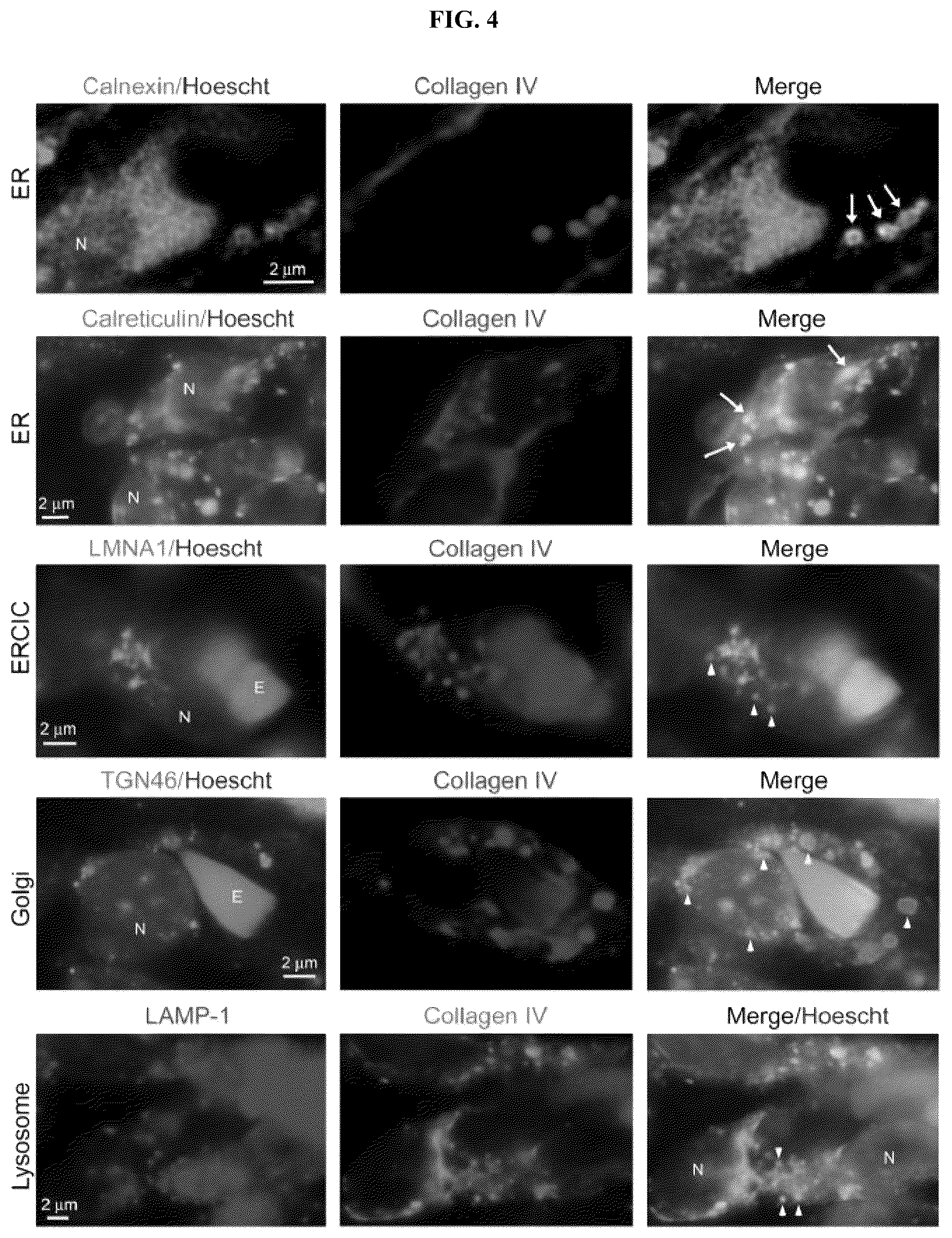 Patent US12472189 Figure 4 – Treatment and prevention of capillary malformation-arteriovenous malformation