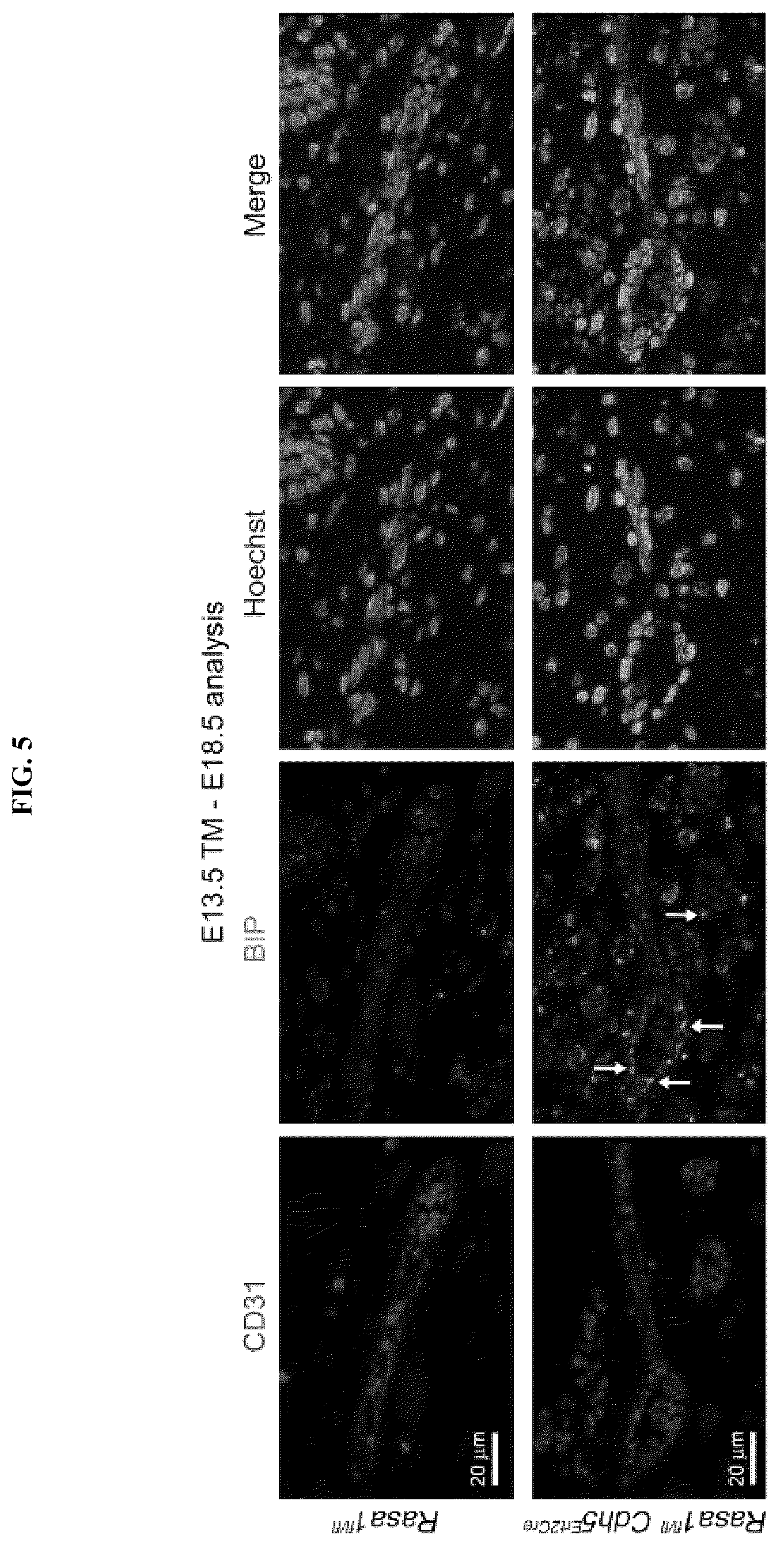 Patent US12472189 Figure 5 – Treatment and prevention of capillary malformation-arteriovenous malformation