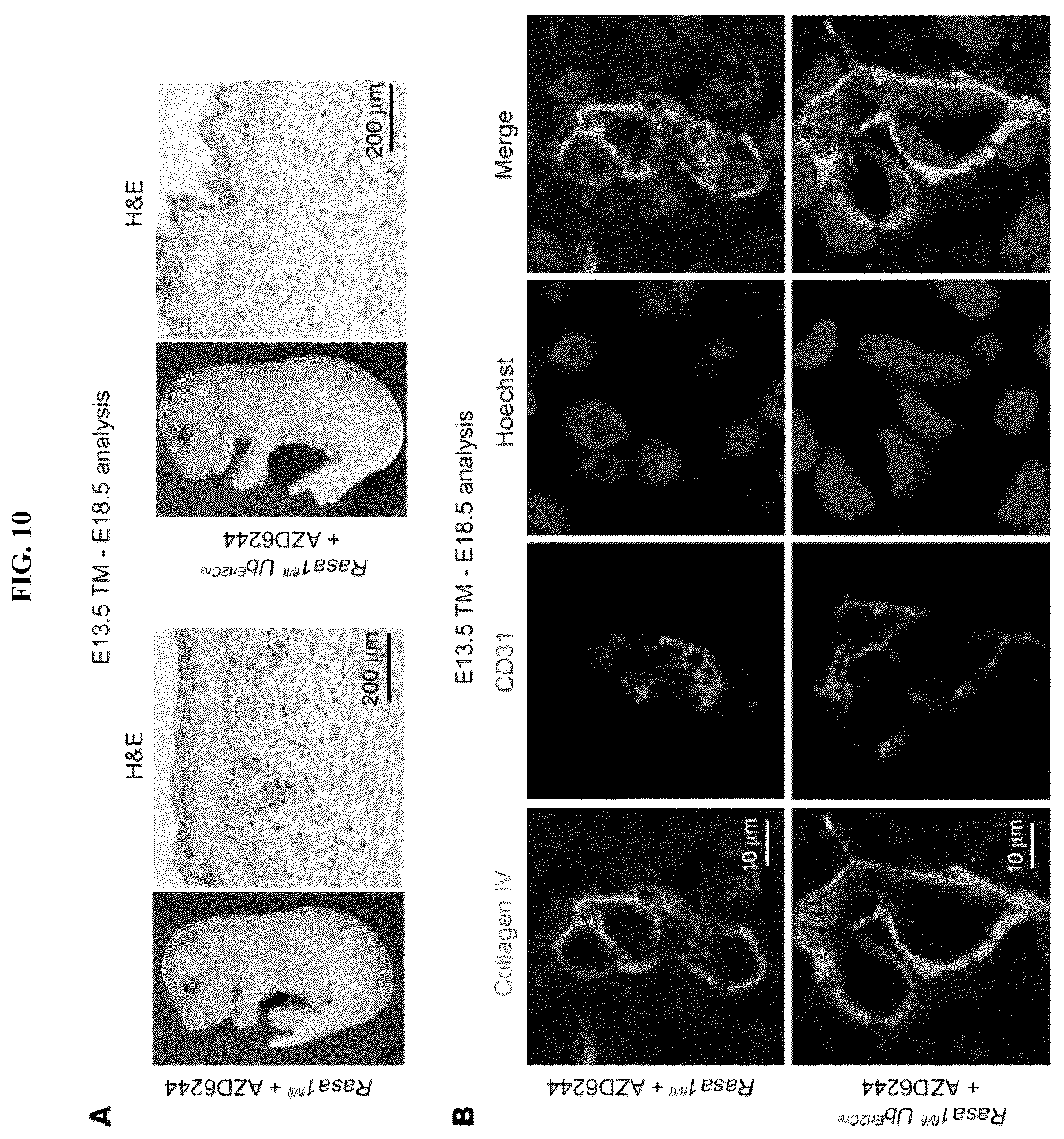 Patent US12472189 Figure 10 – Treatment and prevention of capillary malformation-arteriovenous malformation