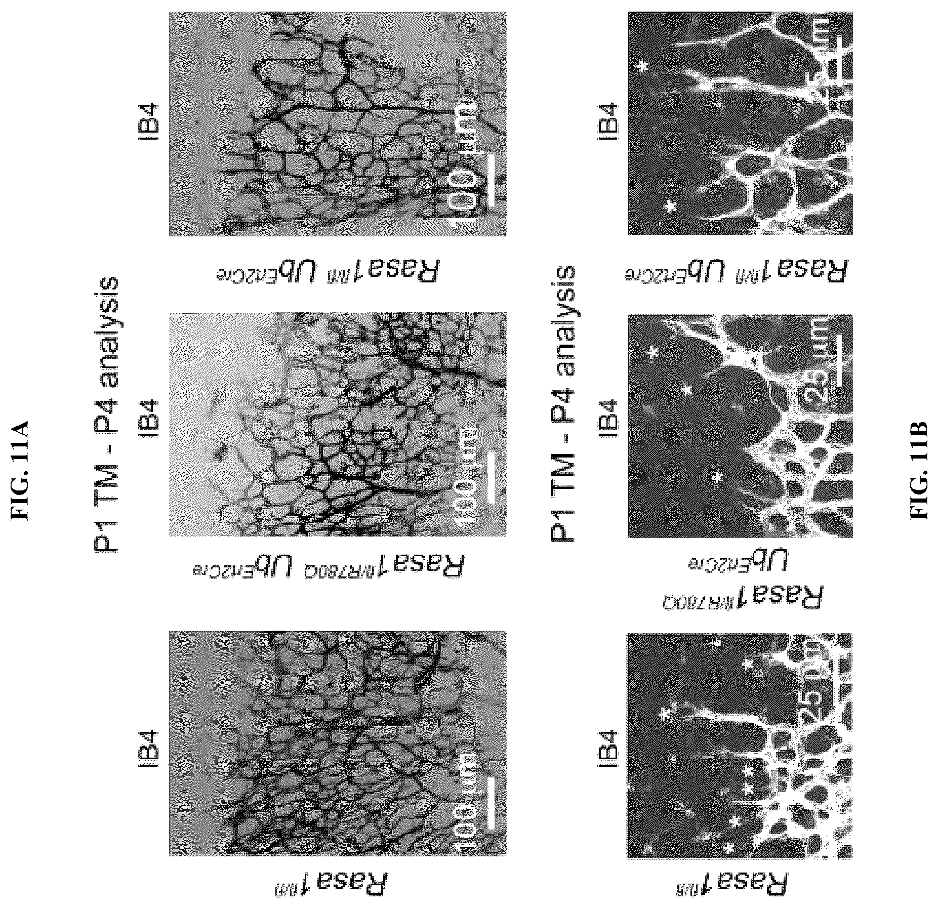 Patent US12472189 Figure 11 – Treatment and prevention of capillary malformation-arteriovenous malformation