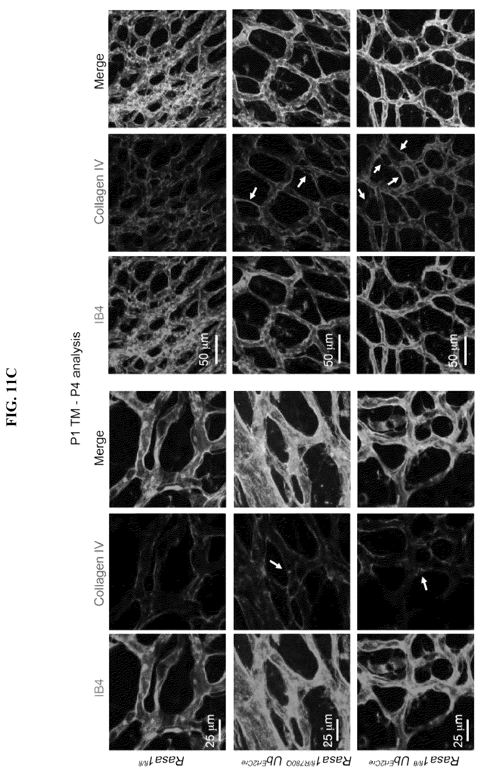 Patent US12472189 Figure 12 – Treatment and prevention of capillary malformation-arteriovenous malformation