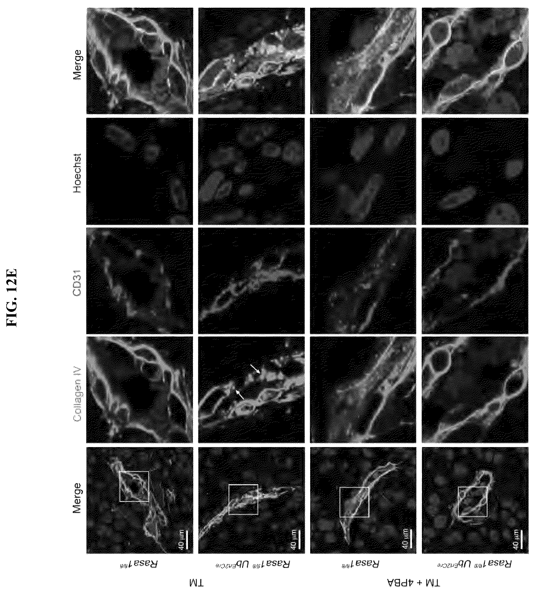 Patent US12472189 Figure 15 – Treatment and prevention of capillary malformation-arteriovenous malformation