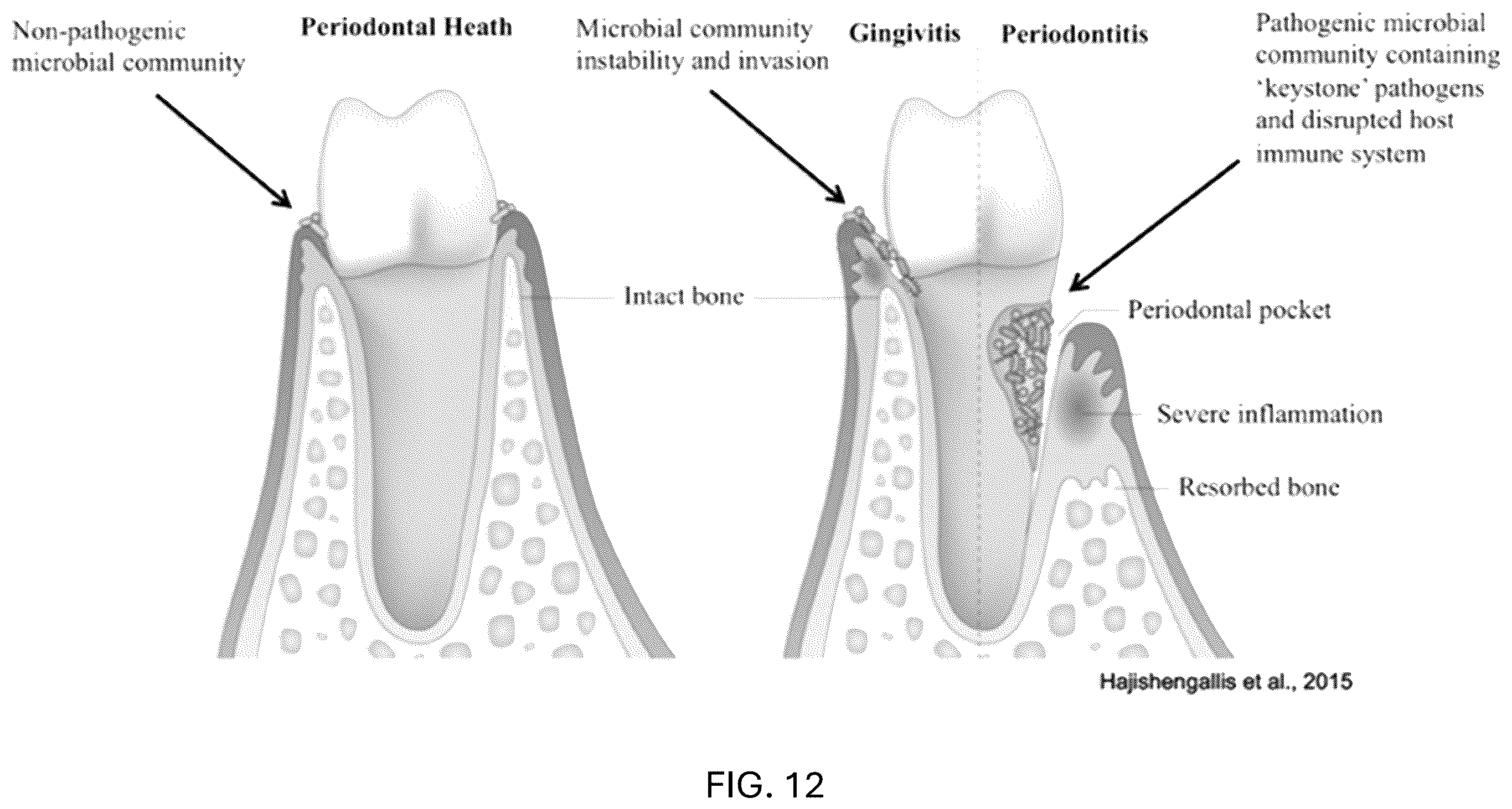 Patent US12472213 Figure 16 – Strains of Lactobacillus delbrueckii which inhibit Porphyromonas gingivalis