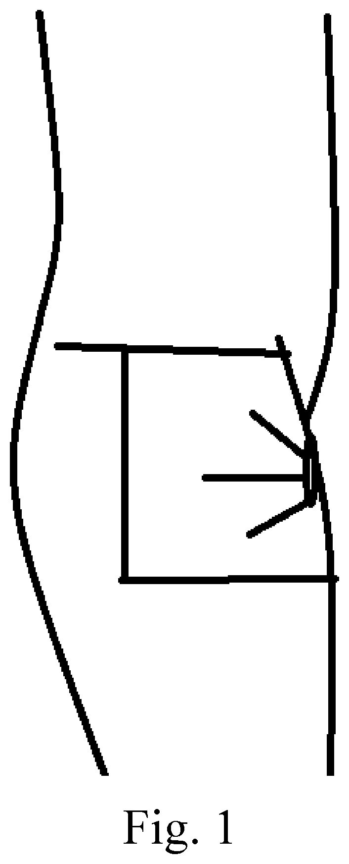 Patent US12472283 Figure 1 – Method of performing a buttocks and hip augmentation using plasma gel