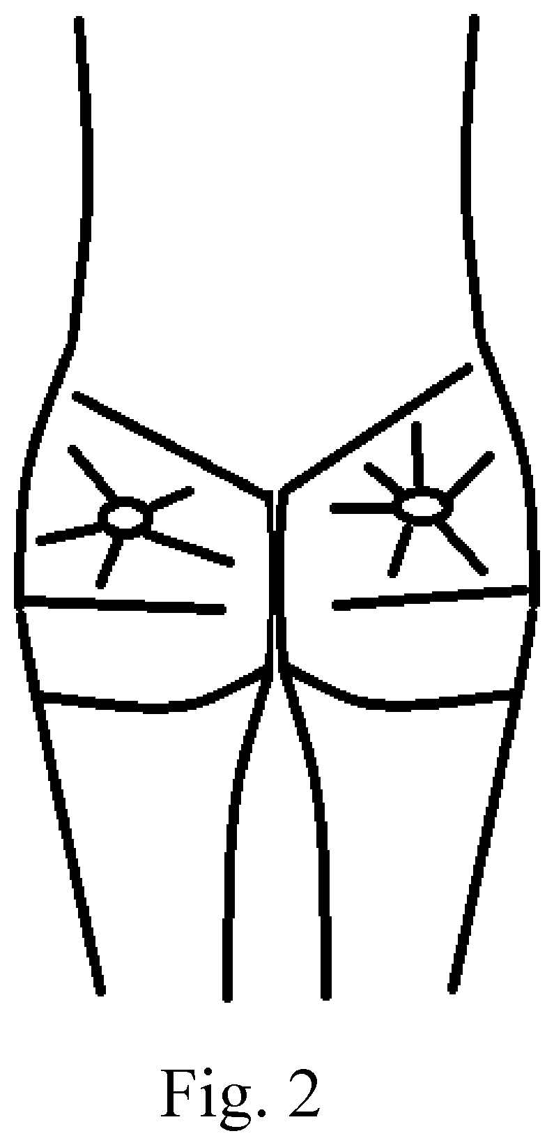 Patent US12472283 Figure 2 – Method of performing a buttocks and hip augmentation using plasma gel