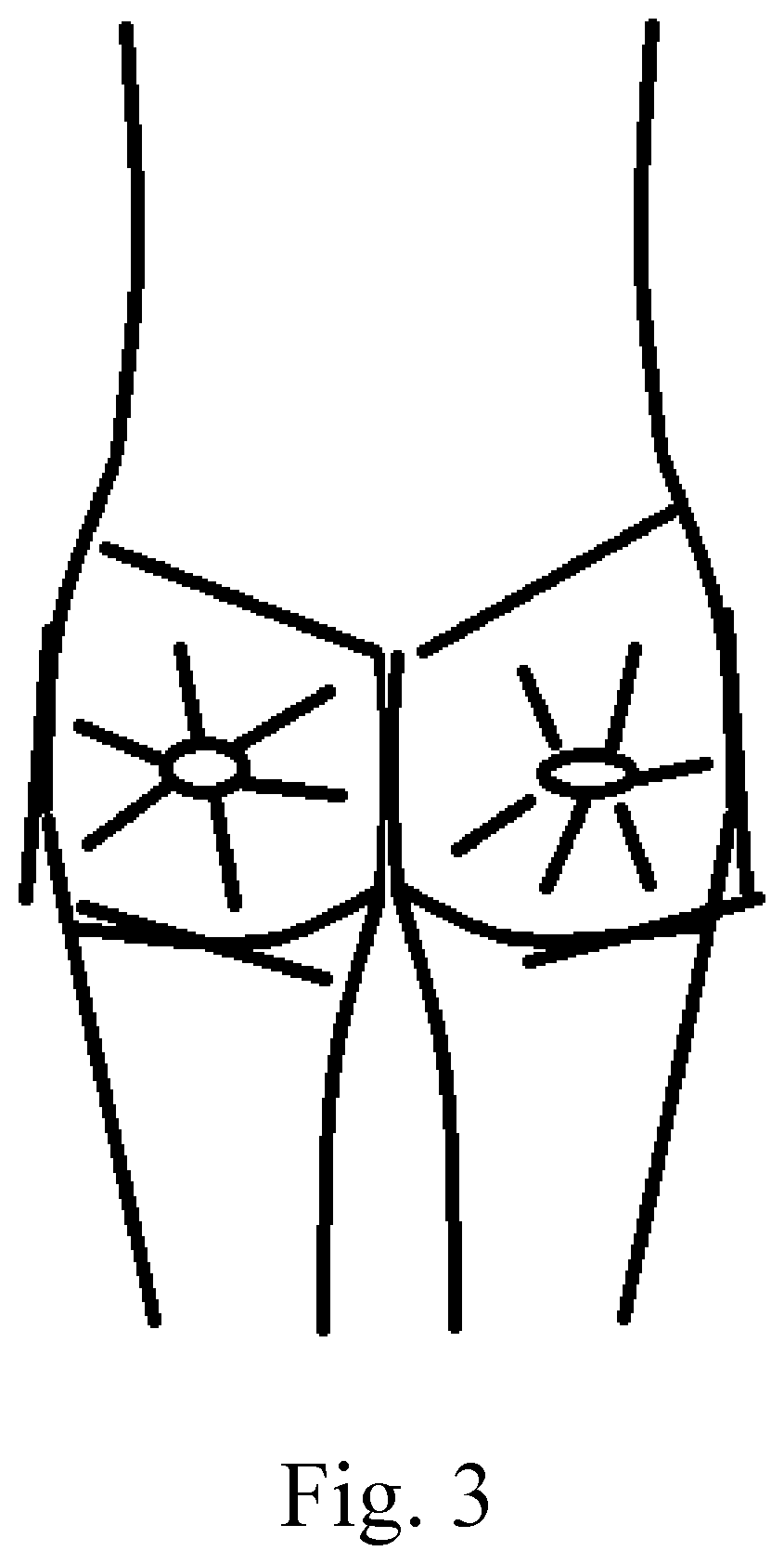 Patent US12472283 Figure 3 – Method of performing a buttocks and hip augmentation using plasma gel