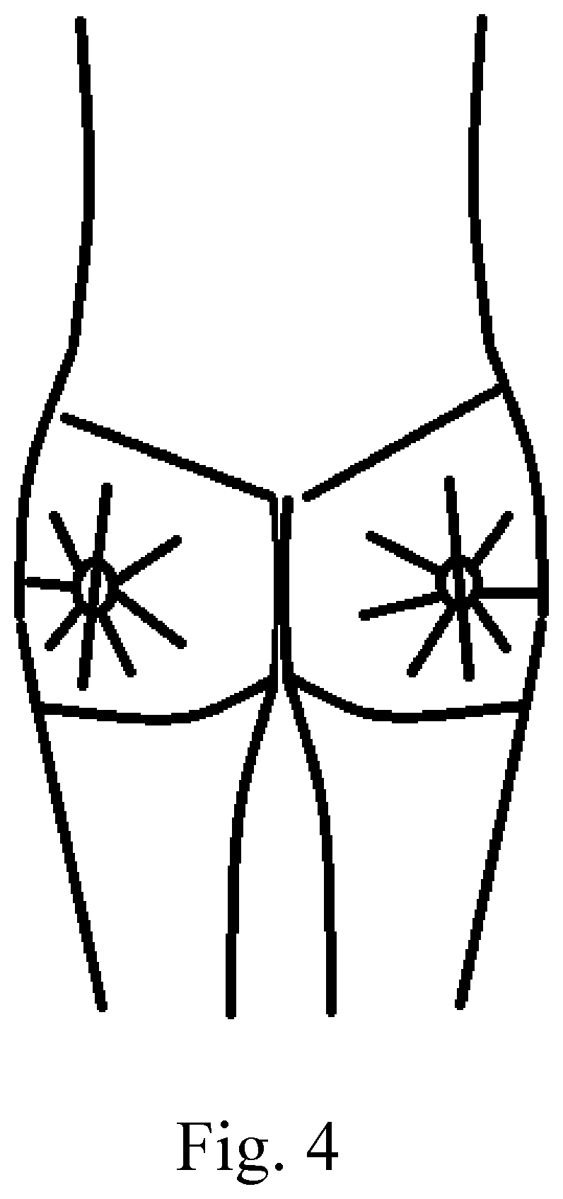 Patent US12472283 Figure 4 – Method of performing a buttocks and hip augmentation using plasma gel