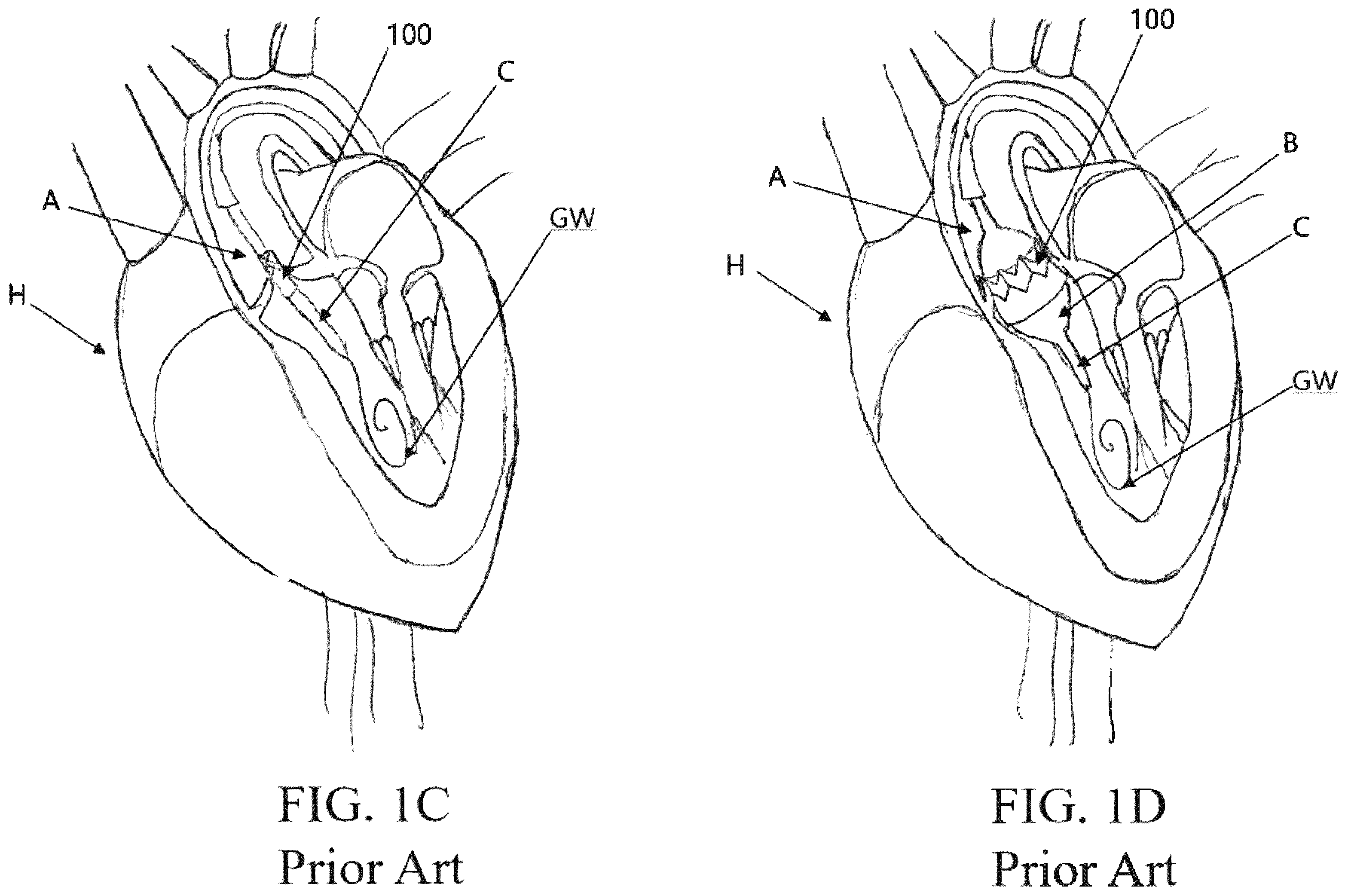 Patent US12472289 Figure 2 – Heart valve that includes coating material