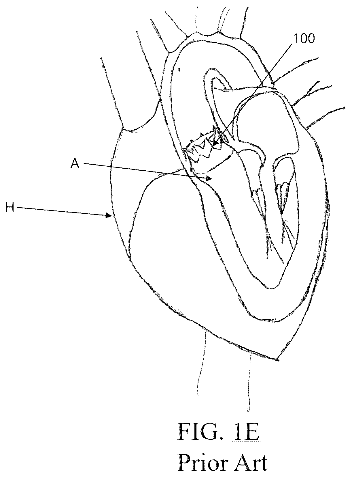 Patent US12472289 Figure 3 – Heart valve that includes coating material