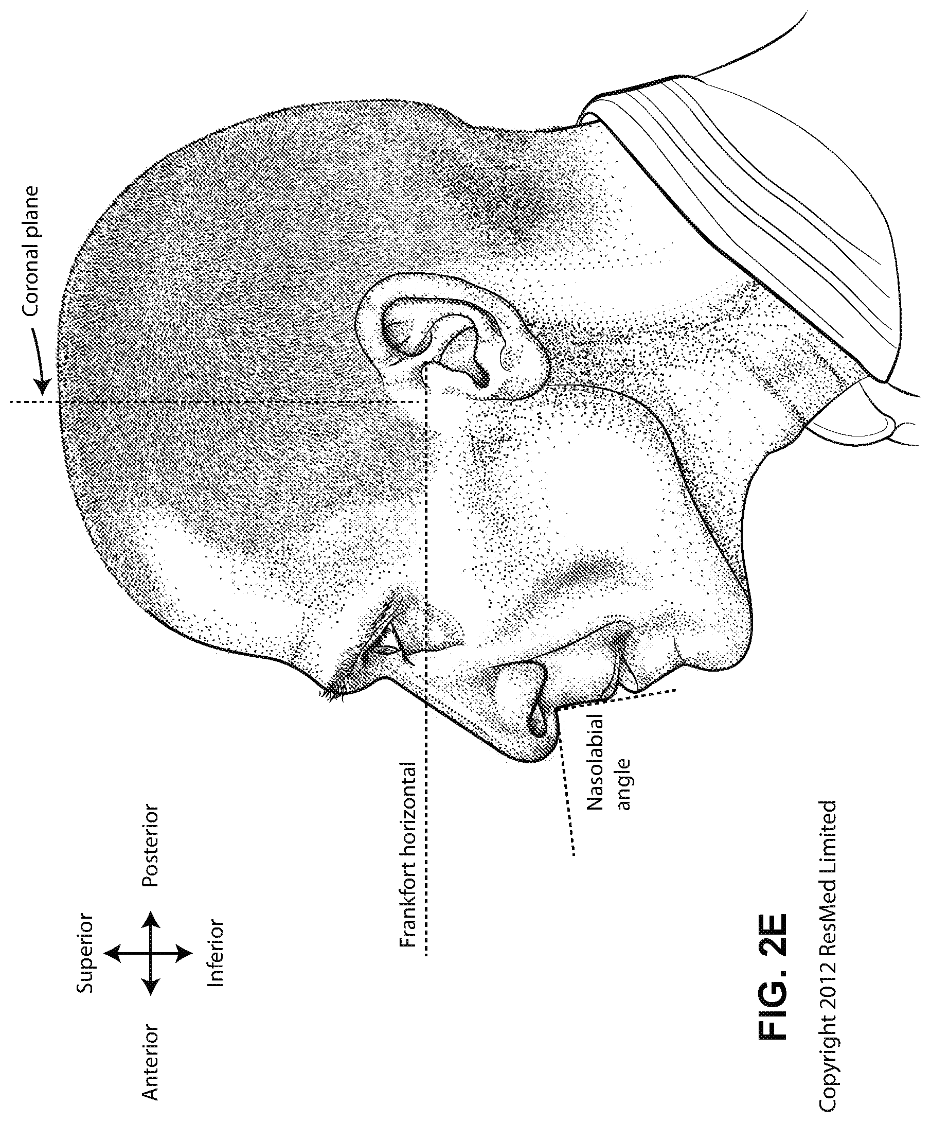Patent US12472322 Figure 8 – Seal-forming structure for patient interface including textile seal member