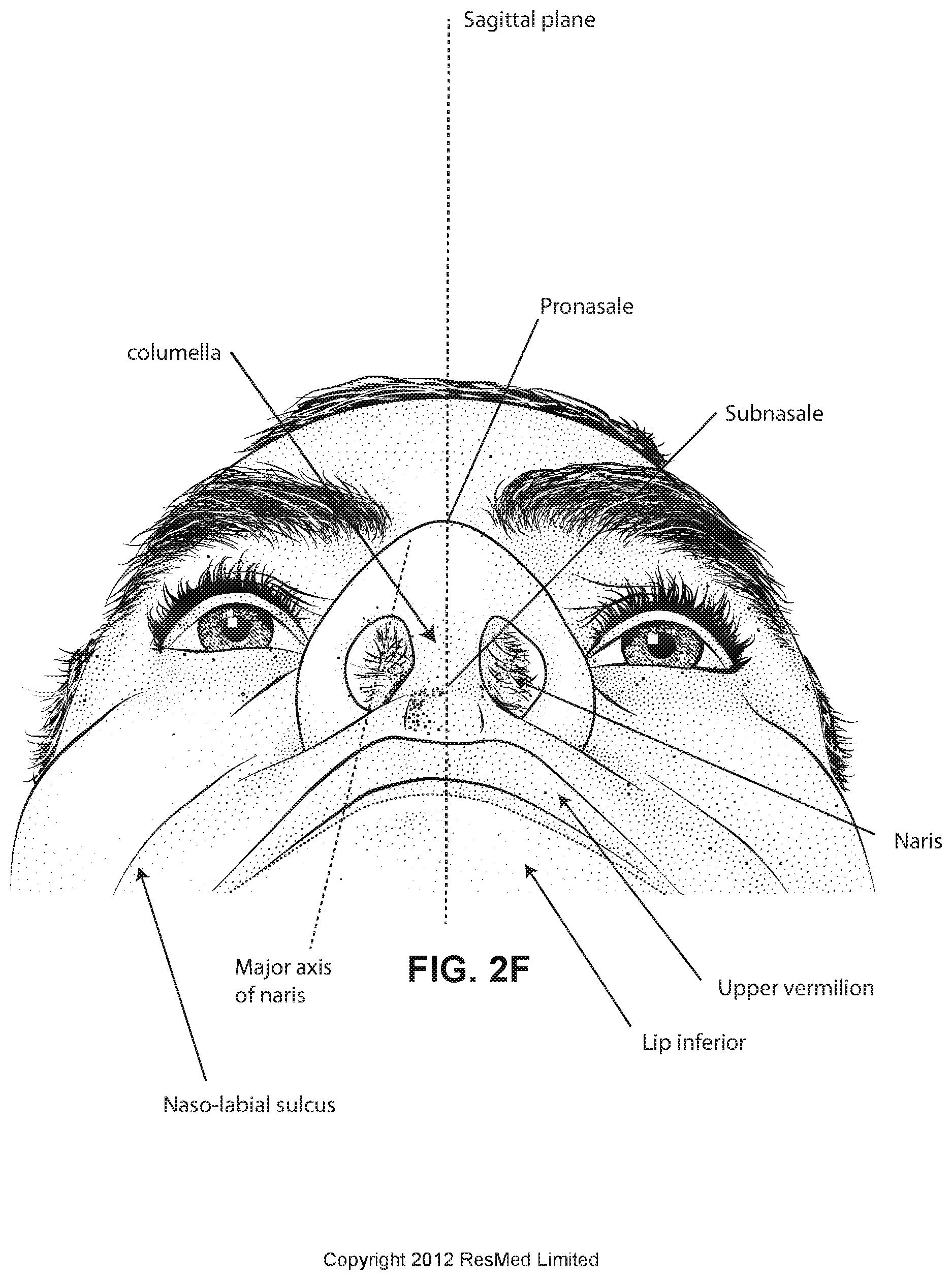 Patent US12472322 Figure 9 – Seal-forming structure for patient interface including textile seal member