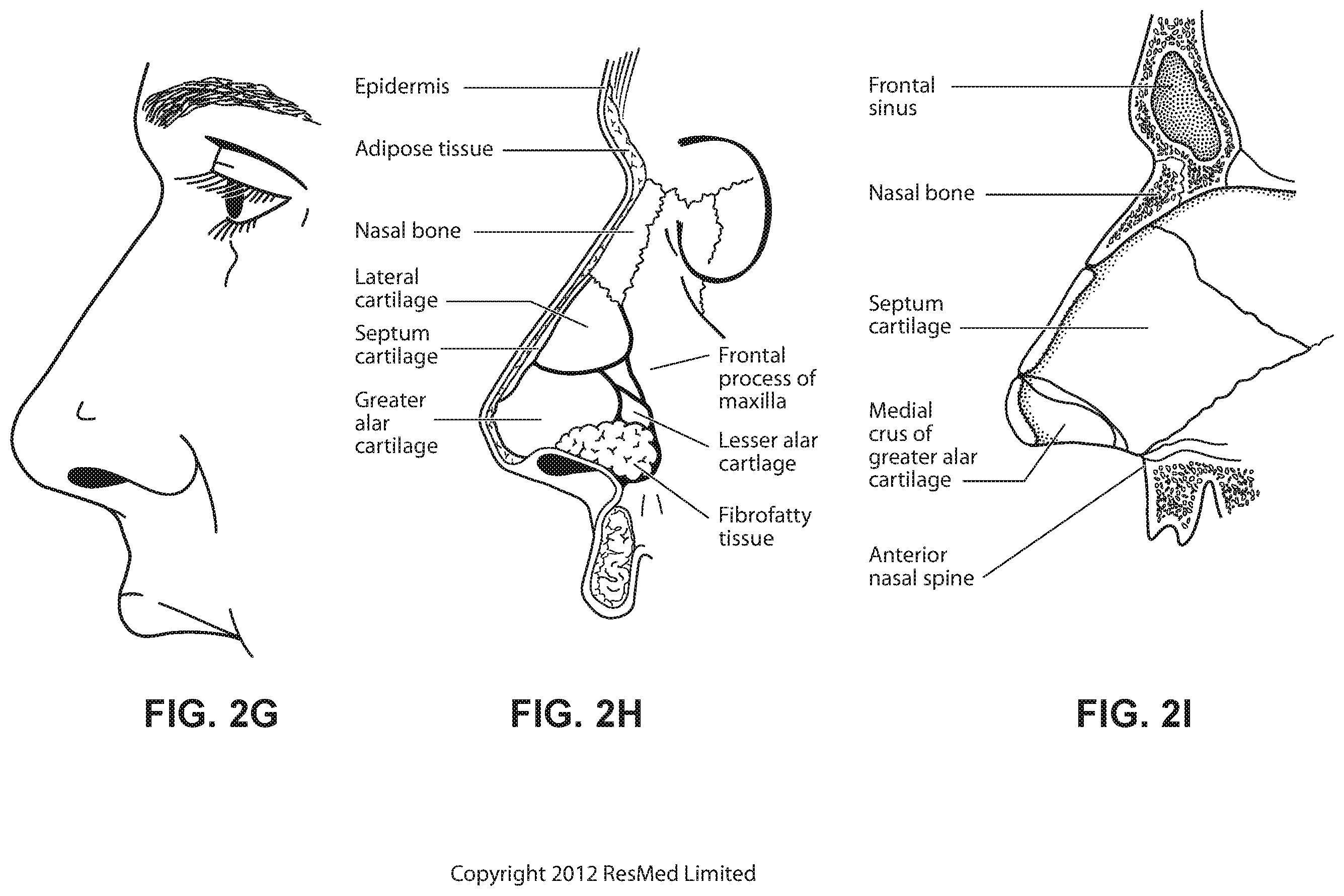 Patent US12472322 Figure 10 – Seal-forming structure for patient interface including textile seal member