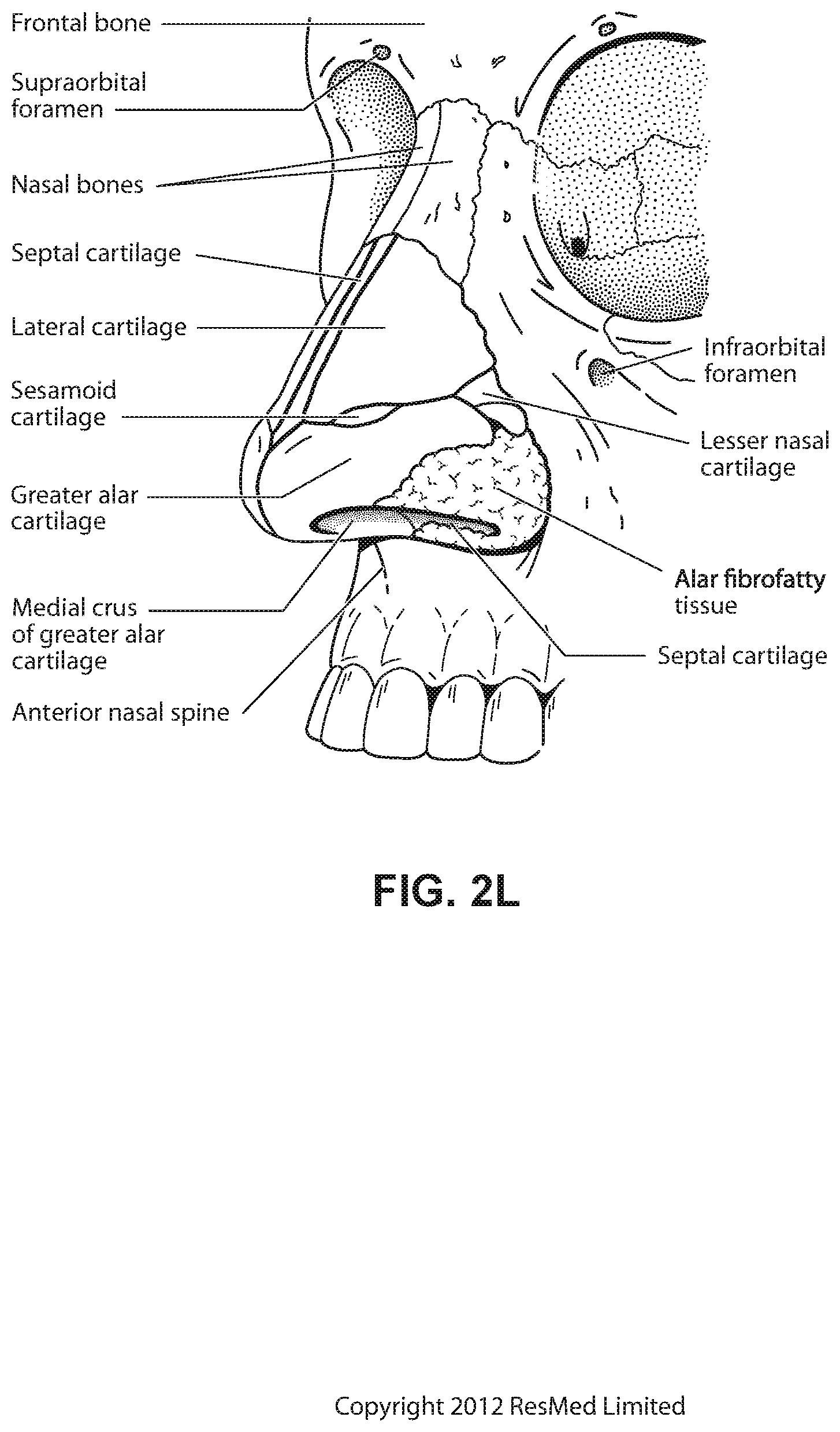 Patent US12472322 Figure 12 – Seal-forming structure for patient interface including textile seal member