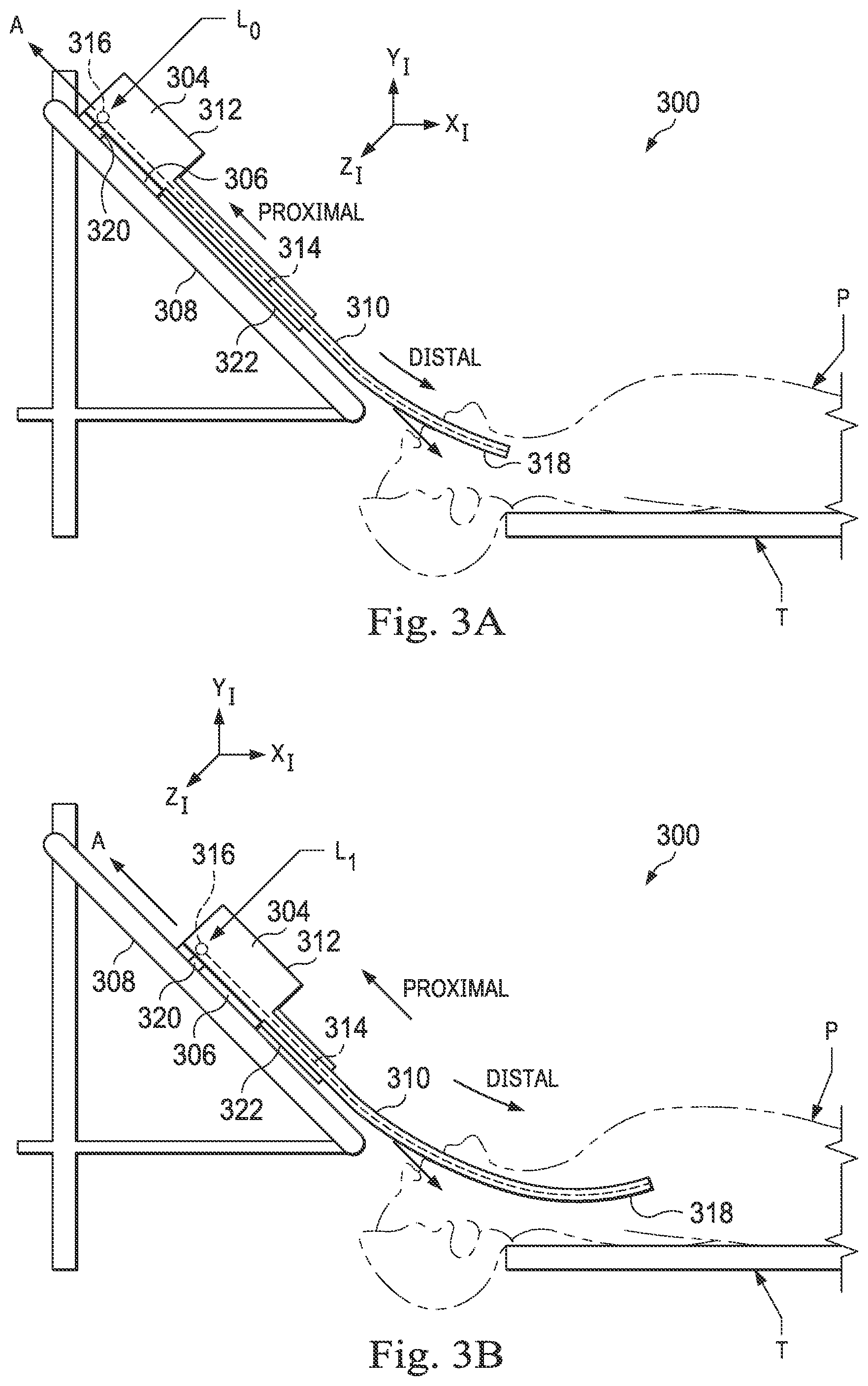 Patent US12472328 Figure 3 – Systems and methods for determining buckling and patient movement during a medical procedure