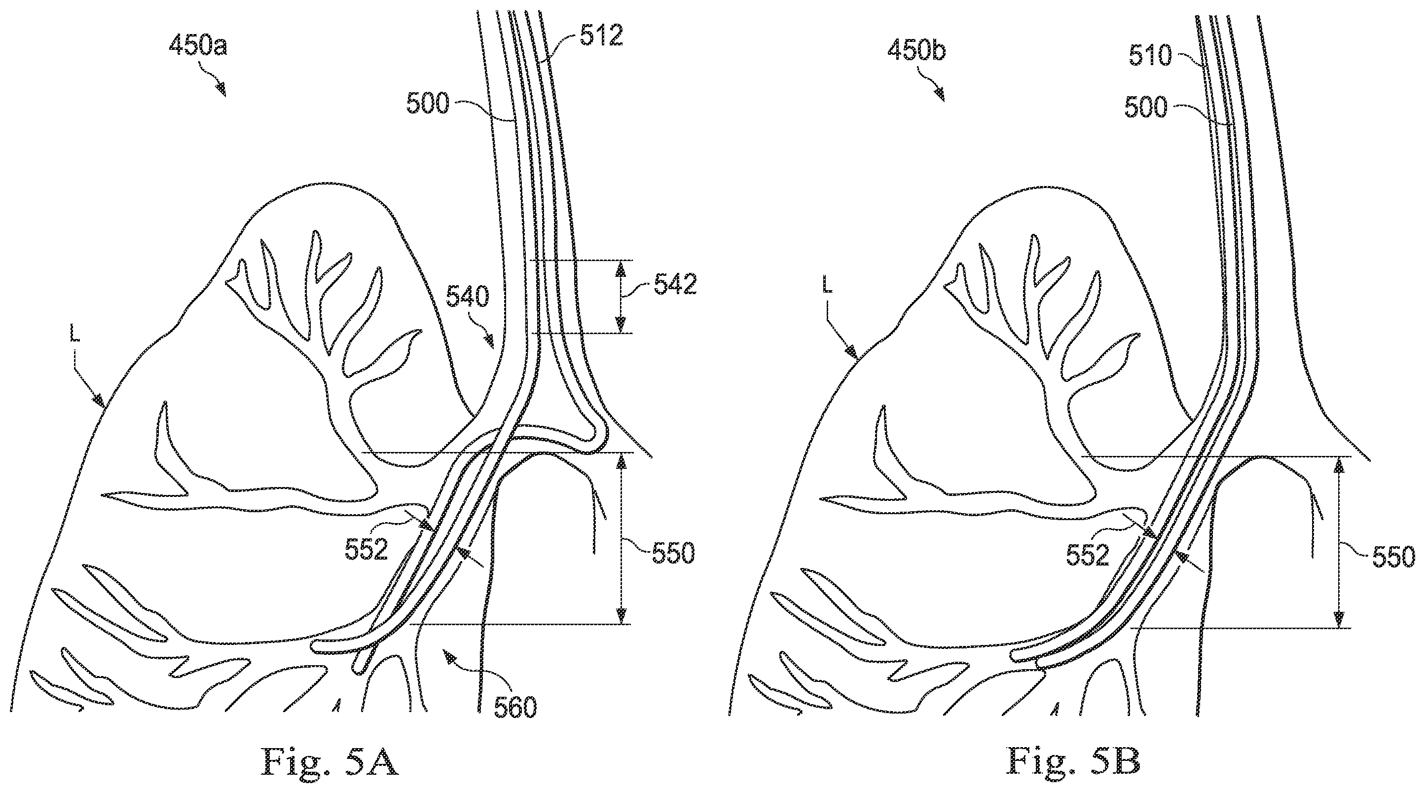 Patent US12472328 Figure 5 – Systems and methods for determining buckling and patient movement during a medical procedure