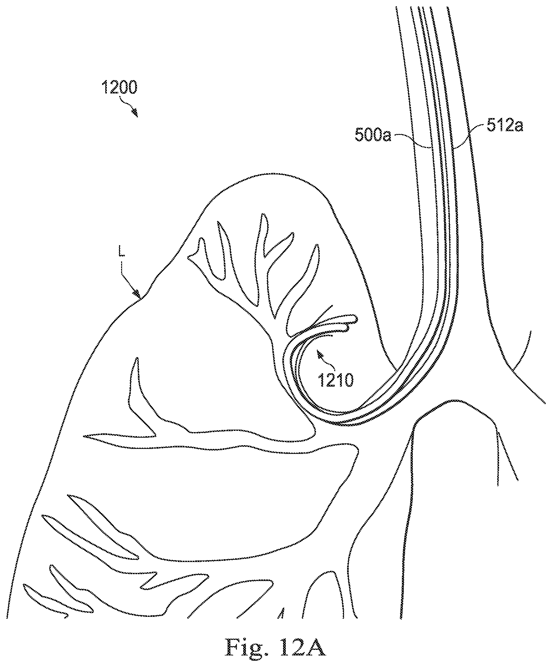 Patent US12472328 Figure 12 – Systems and methods for determining buckling and patient movement during a medical procedure
