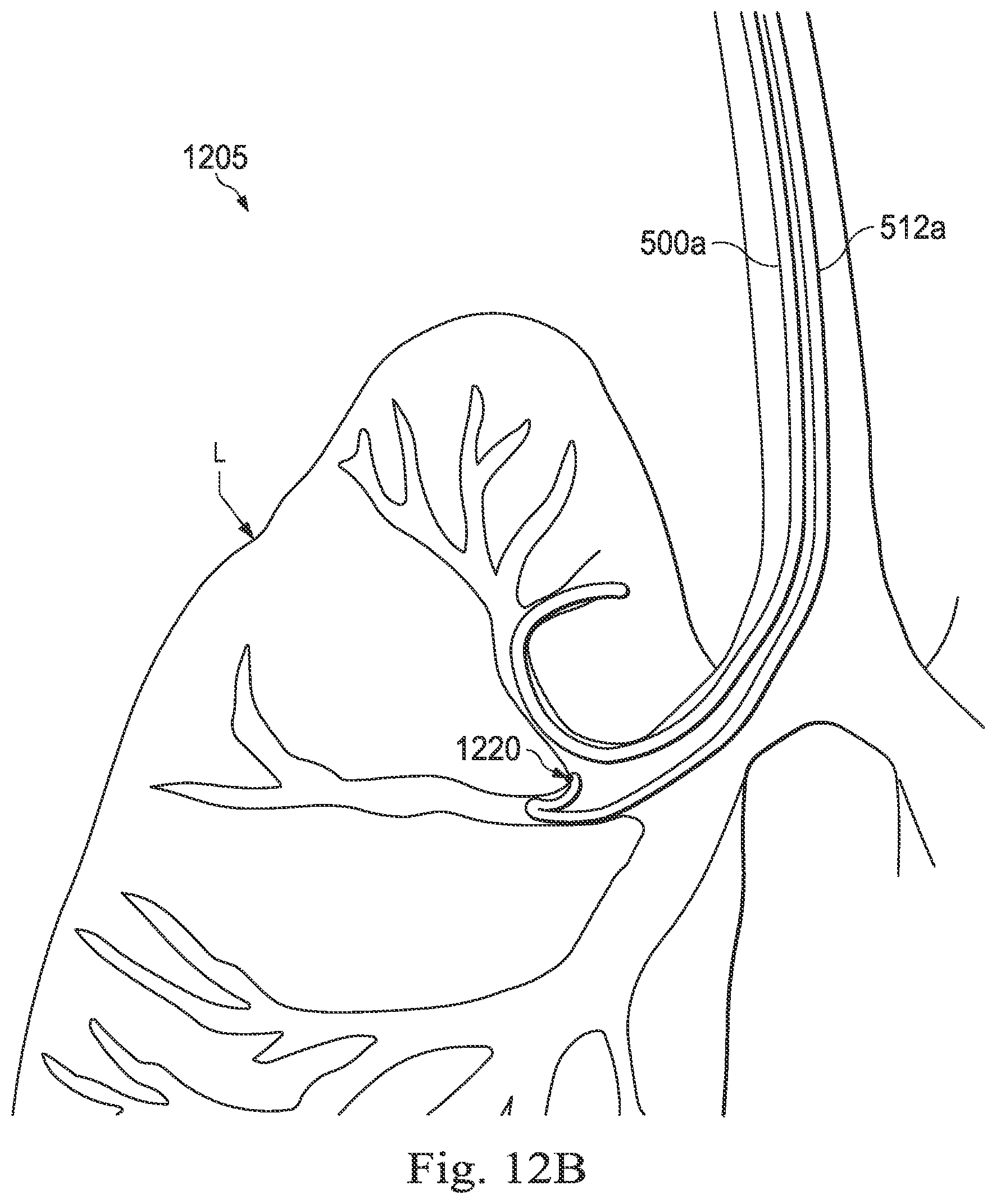 Patent US12472328 Figure 13 – Systems and methods for determining buckling and patient movement during a medical procedure
