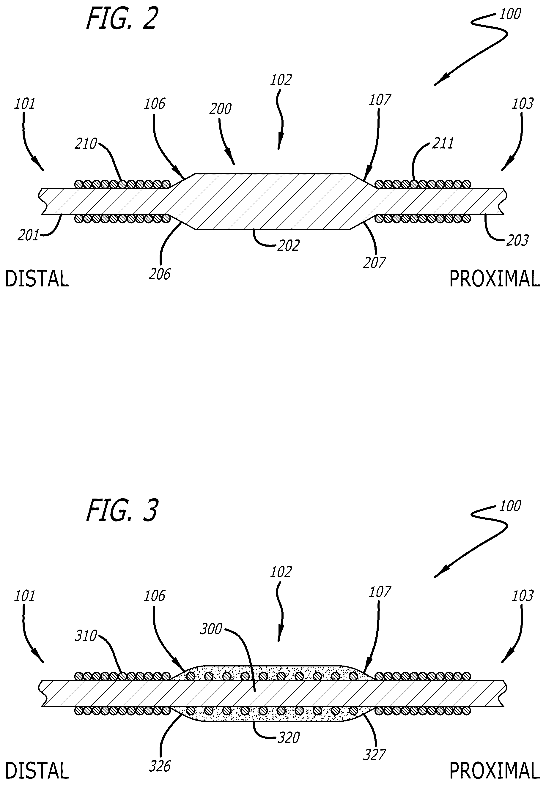 Patent US12472331 Figure 2 – Needle tip blunting using a length of a guidewire