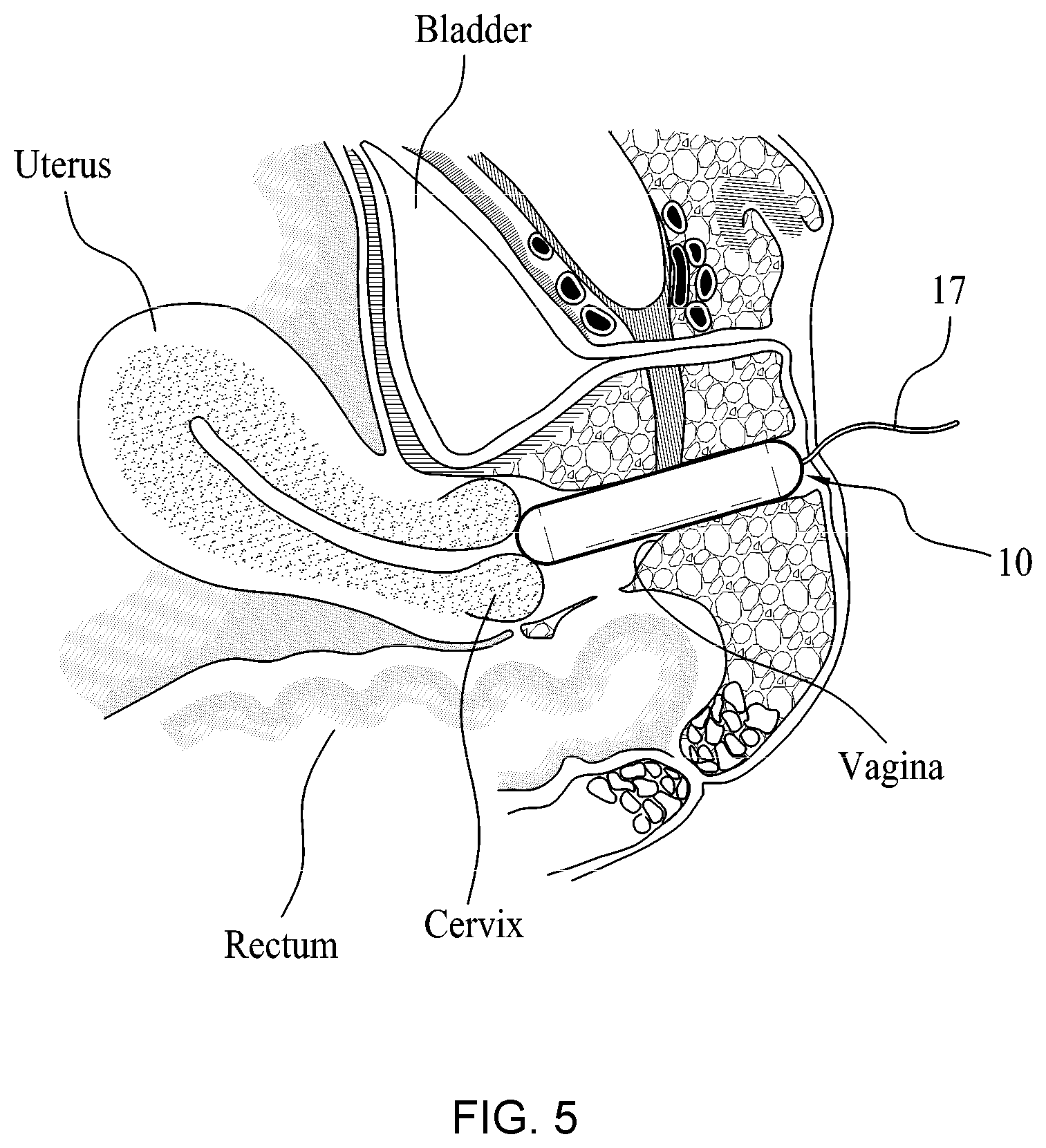 Patent US12472332 Figure 6 – Apparatus and method for inactivating infectious organisms in human body