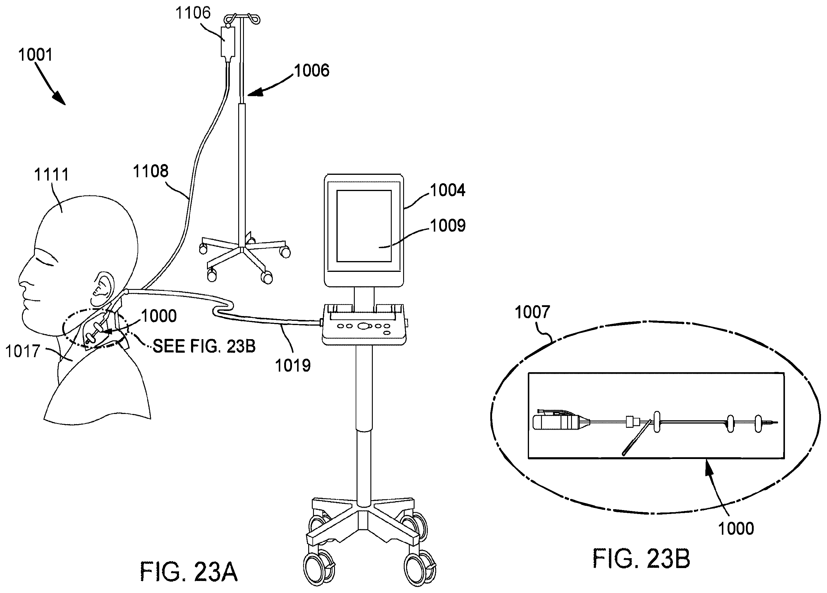 Patent US12472334 Figure 15 – Systems and methods for treatment of fluid overload