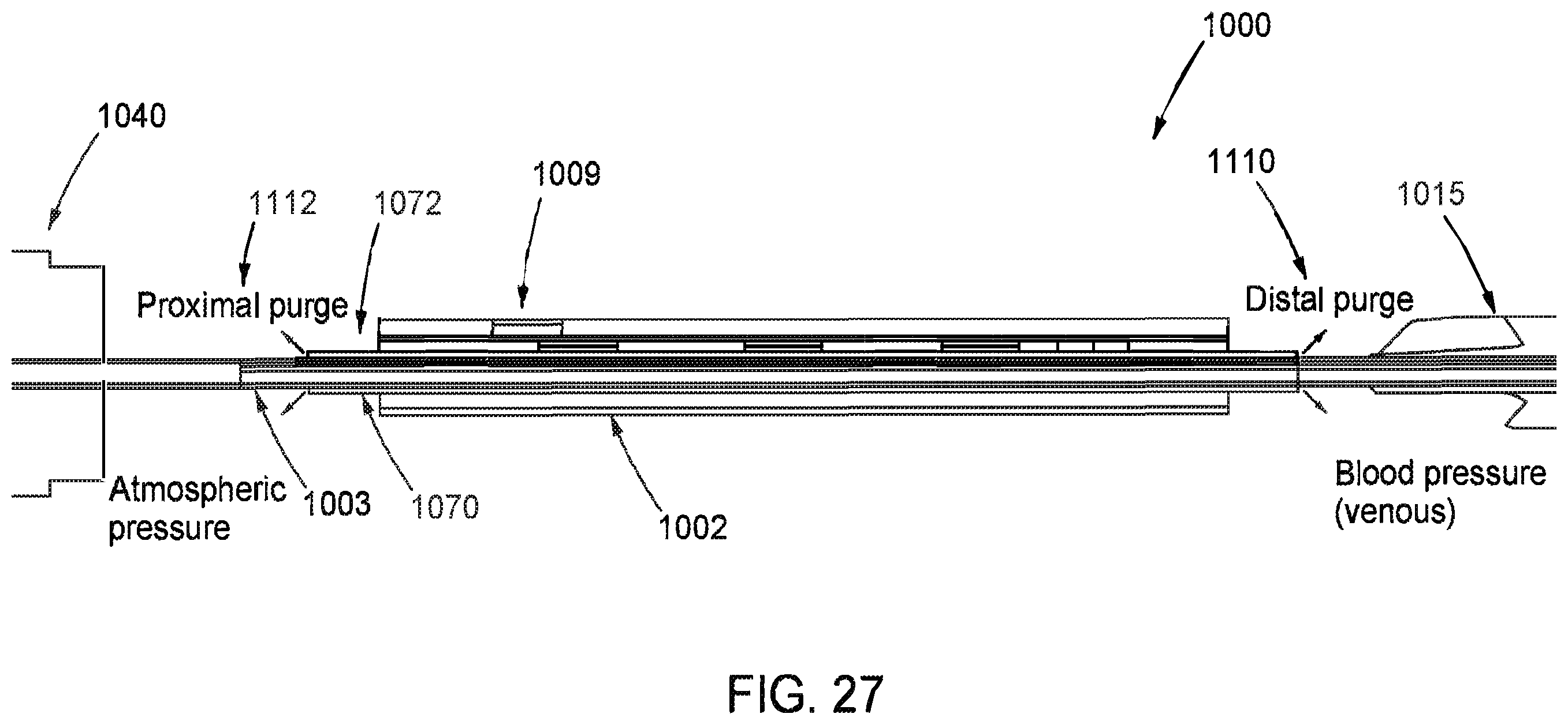 Patent US12472334 Figure 18 – Systems and methods for treatment of fluid overload