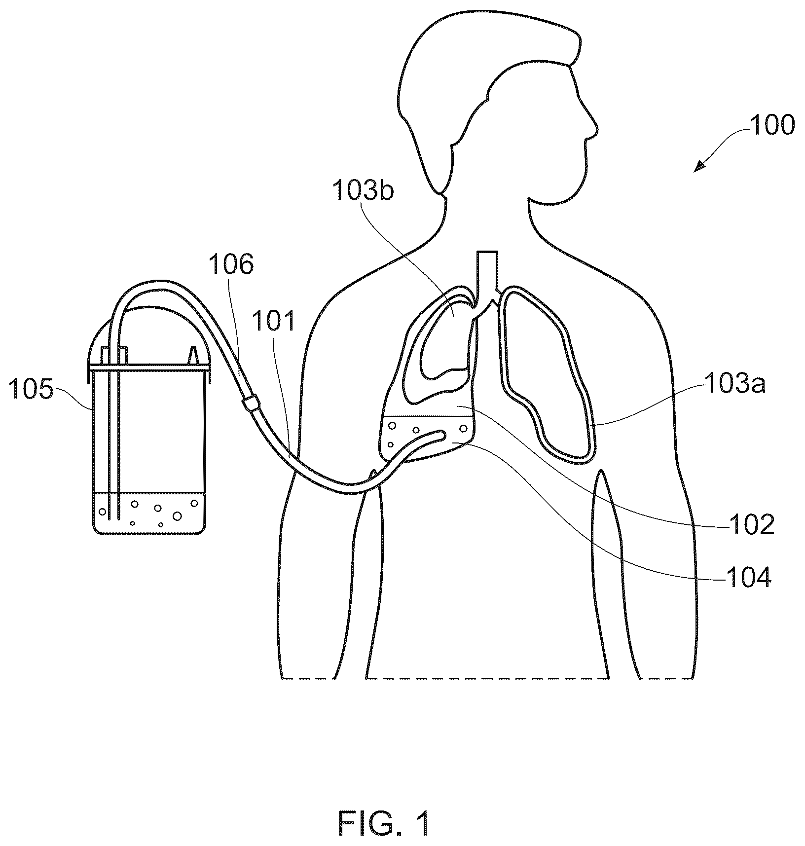 Patent US12472341 Figure 1 – Chest drain connector