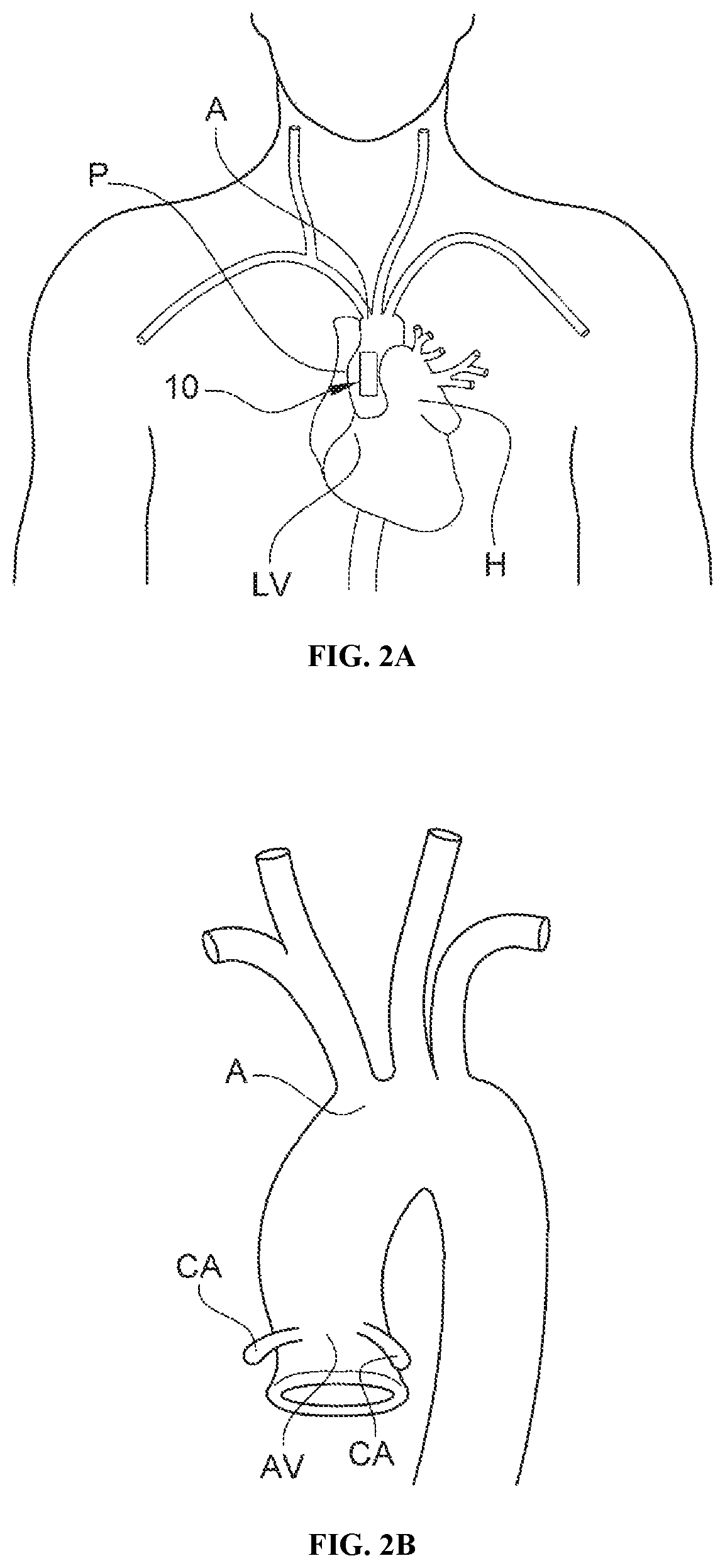 Patent US12472344 Figure 2 – Left ventricle unloading device