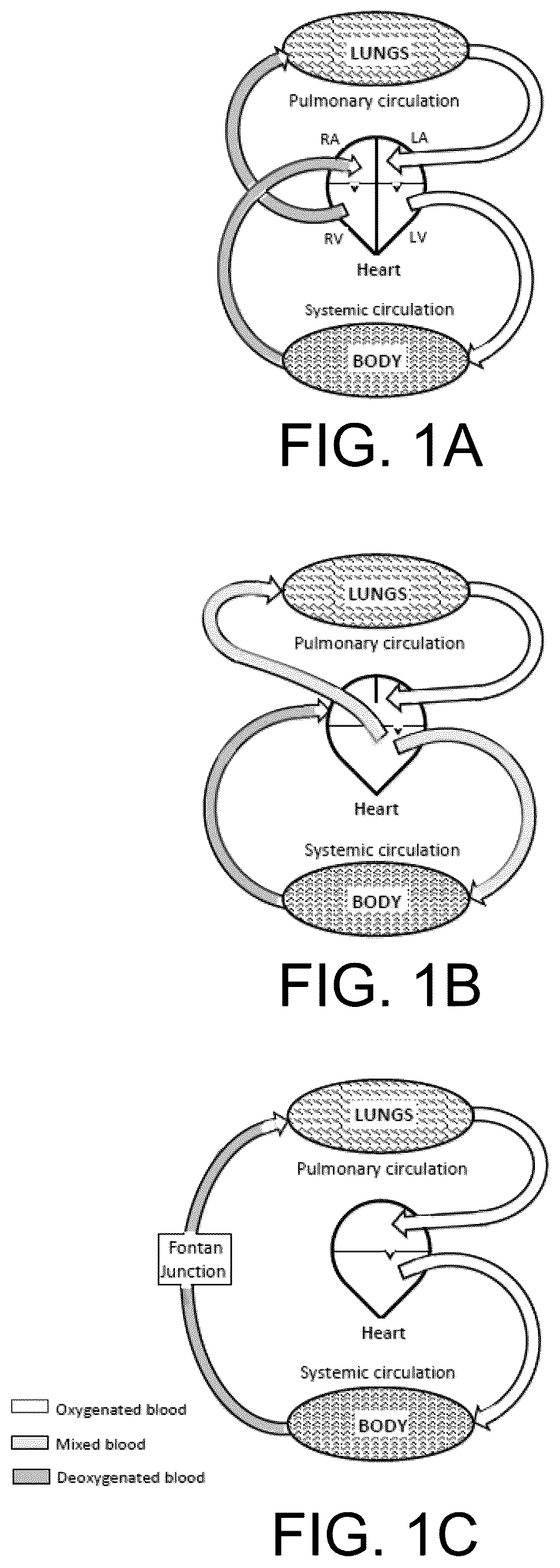 Patent US12472345 Figure 1 – Pulmonary circulation assist implant for a univentricular heart