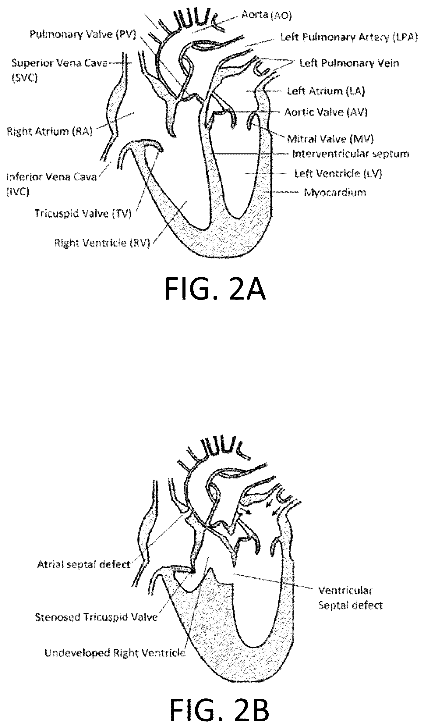 Patent US12472345 Figure 2 – Pulmonary circulation assist implant for a univentricular heart