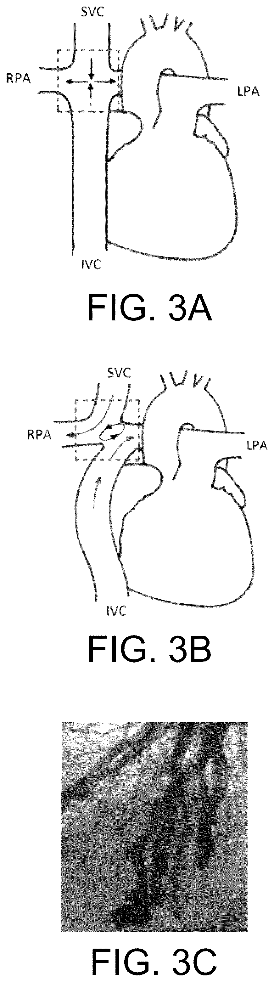 Patent US12472345 Figure 3 – Pulmonary circulation assist implant for a univentricular heart