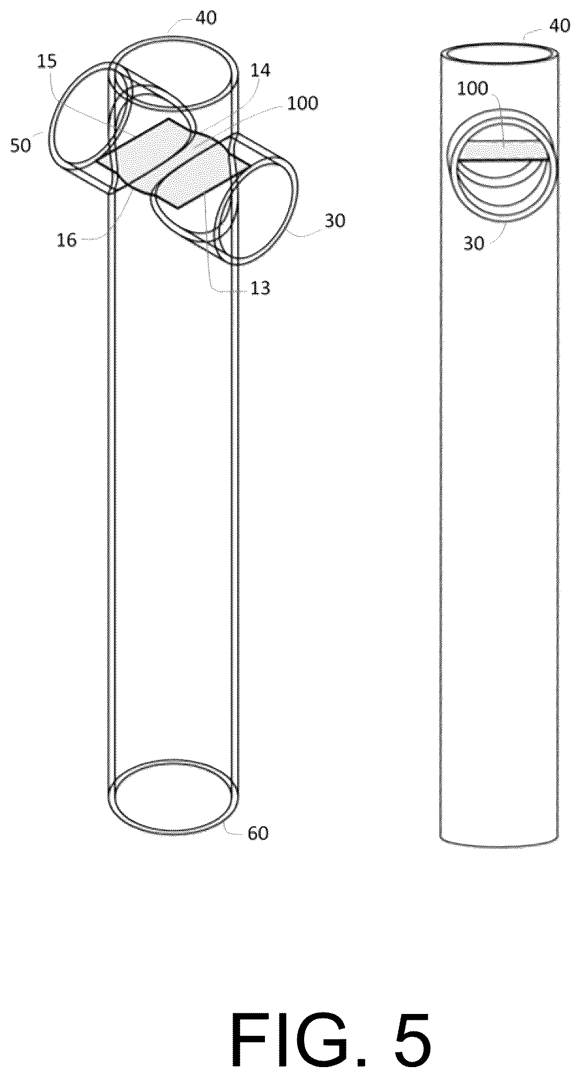 Patent US12472345 Figure 5 – Pulmonary circulation assist implant for a univentricular heart