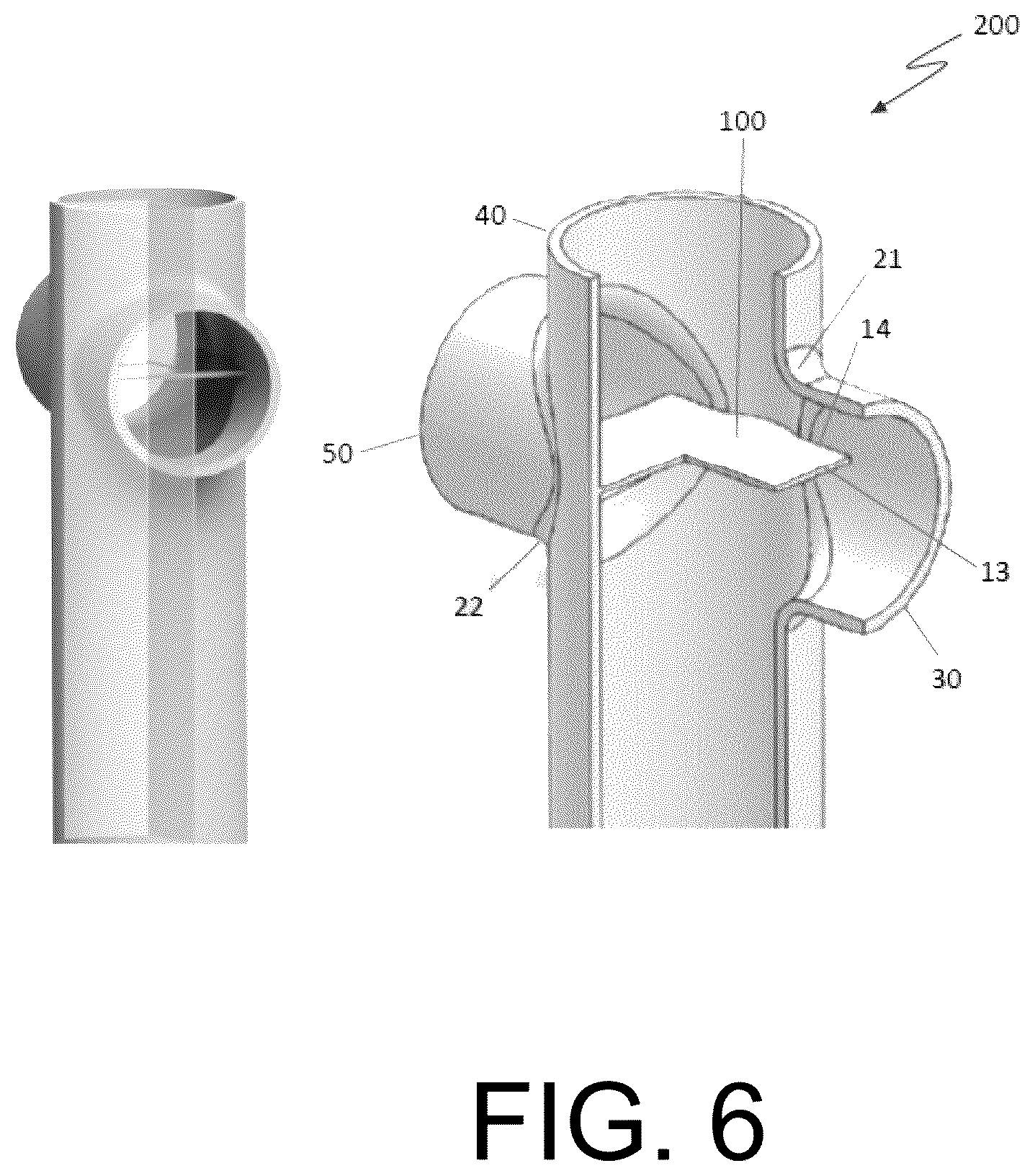 Patent US12472345 Figure 6 – Pulmonary circulation assist implant for a univentricular heart