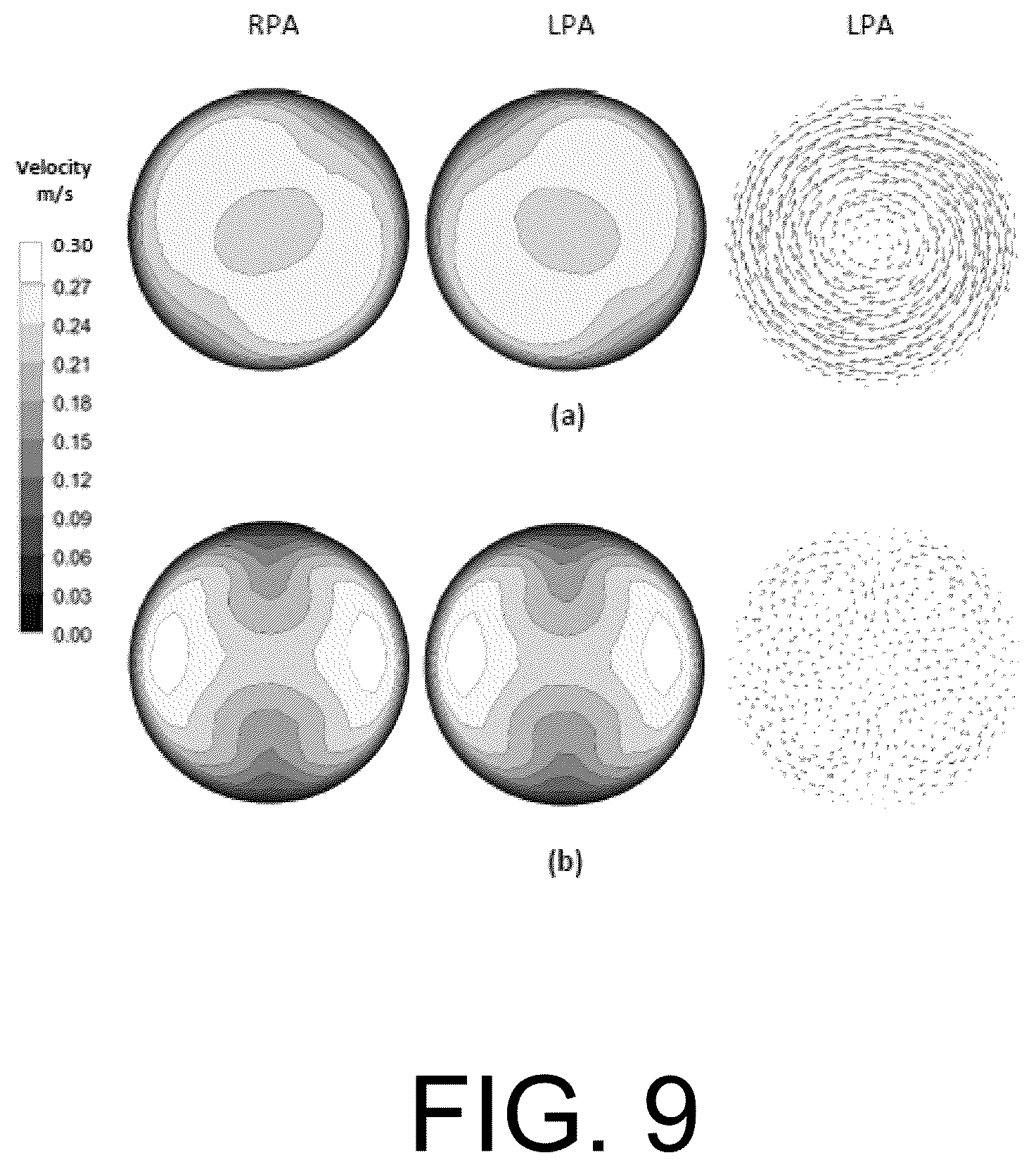 Patent US12472345 Figure 9 – Pulmonary circulation assist implant for a univentricular heart